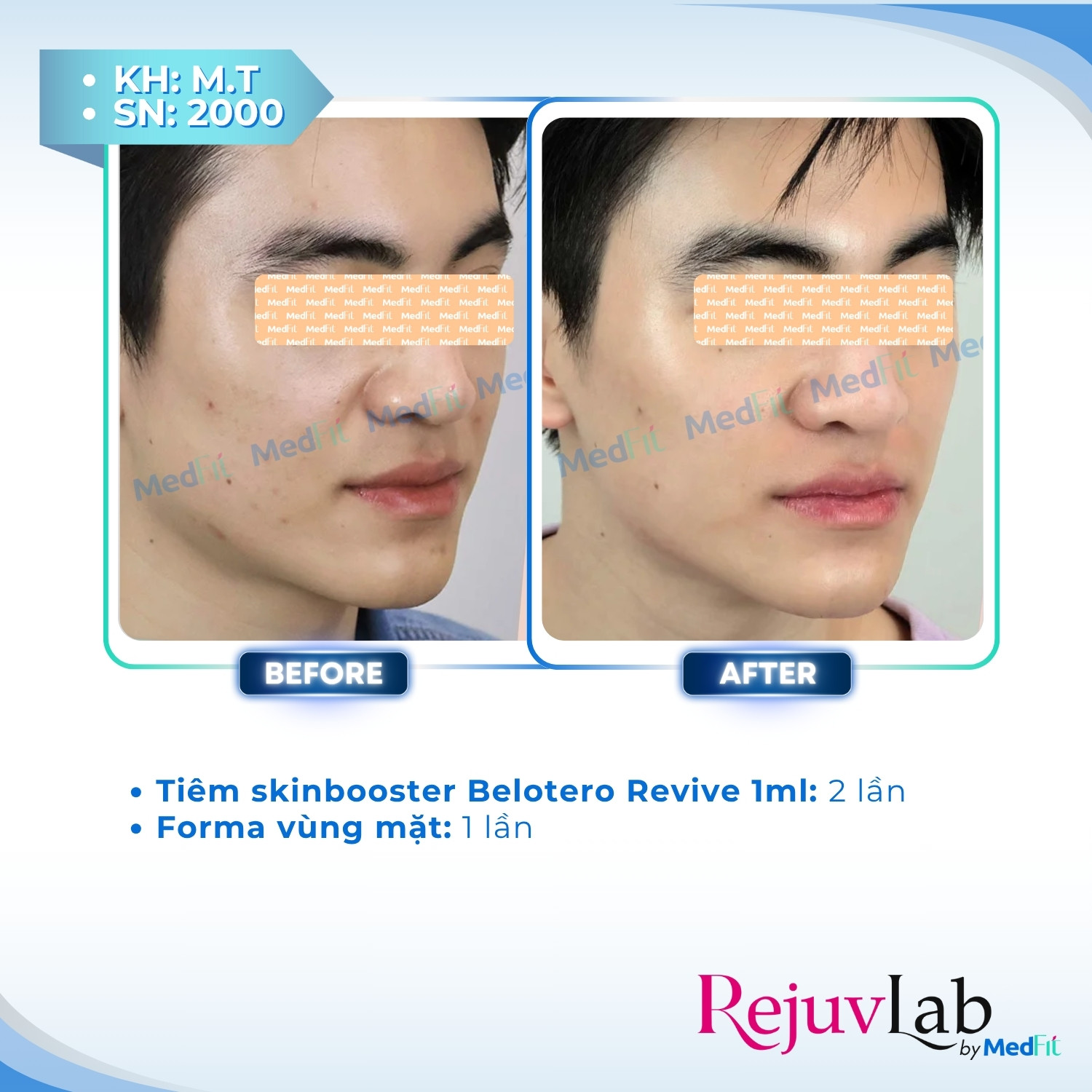 Belotero Revive - Công nghệ tái sinh làn da hoàn hảo 5