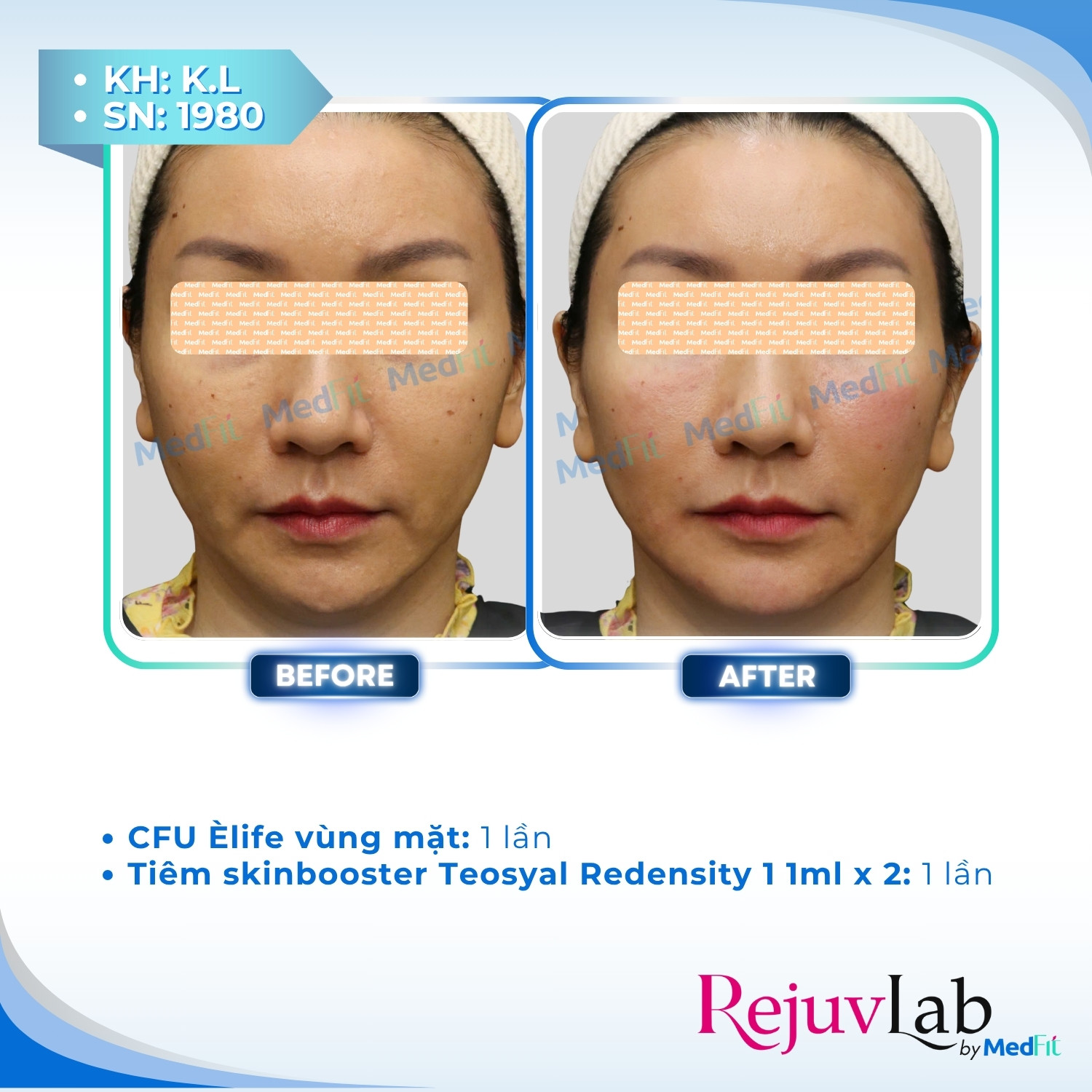 3 CFU Èlife – Công nghệ mới trong nâng cơ, trẻ hóa da và giảm mỡ toàn diện 6