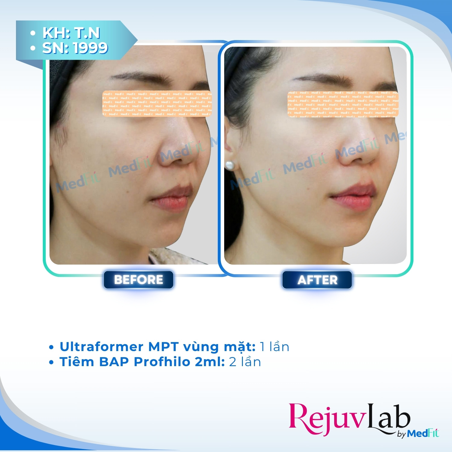 Ultraformer MPT – Đột phá mới trong công nghệ : nâng cơ, giảm mỡ, trẻ hóa da toàn diện 6