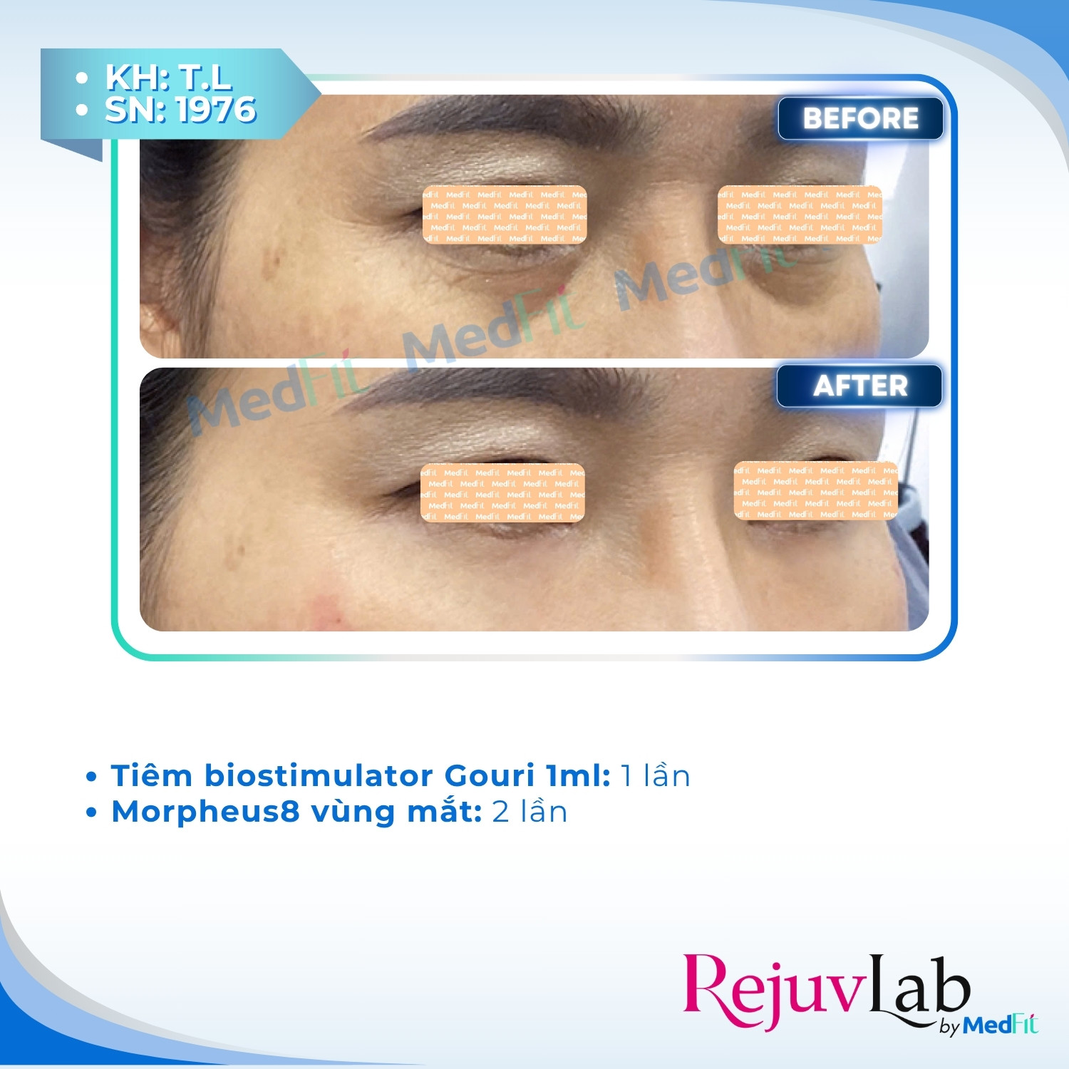 Gouri - Công nghệ kích thích sinh học tiên tiến PCL dạng lỏng 7