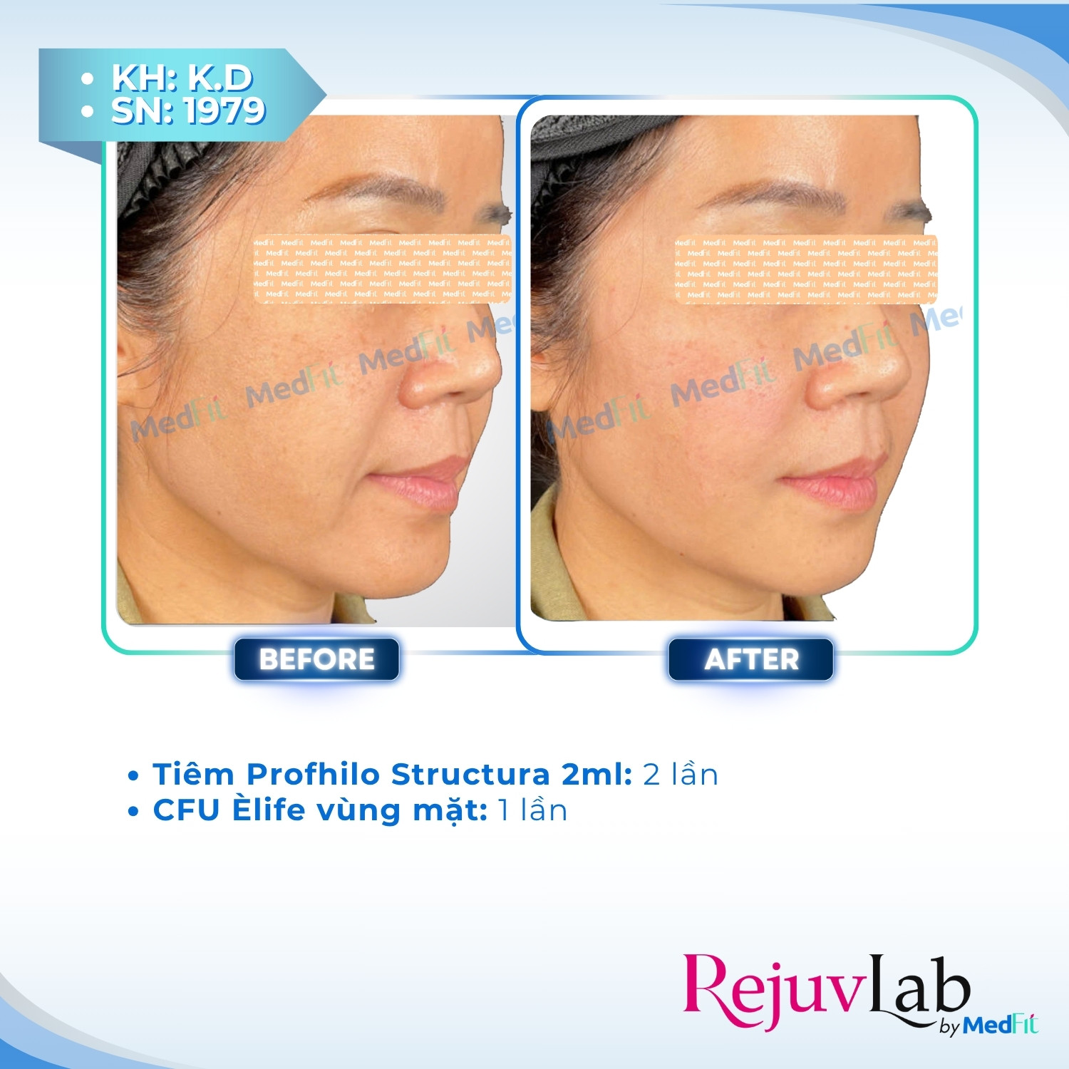 Profhilo Structura – Phương pháp cấp ẩm và trẻ hóa mô mỡ với hyaluronic acid 11