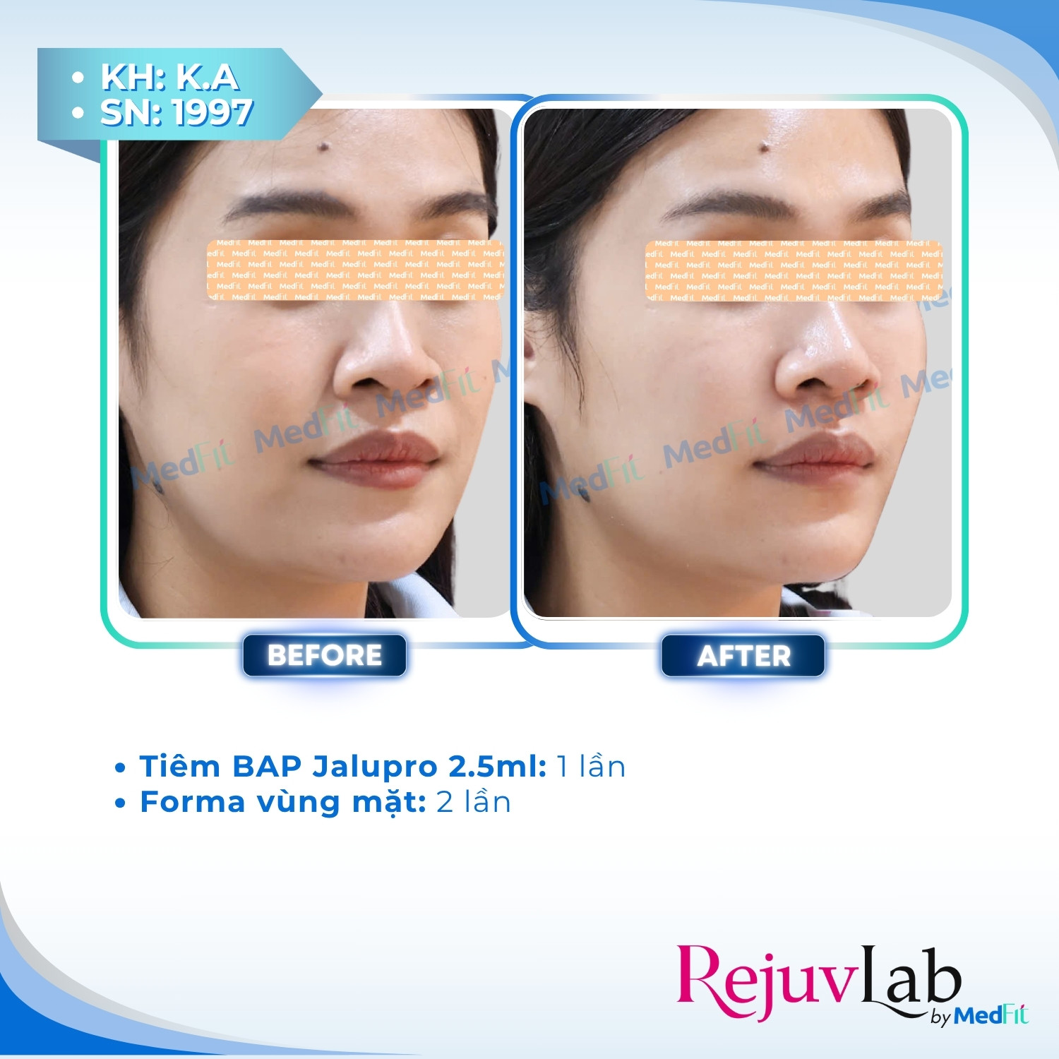 Tiêm B.A.P Jalupro – Phương pháp cấp ẩm và trẻ hóa, tái sinh làn da rạng ngời 6