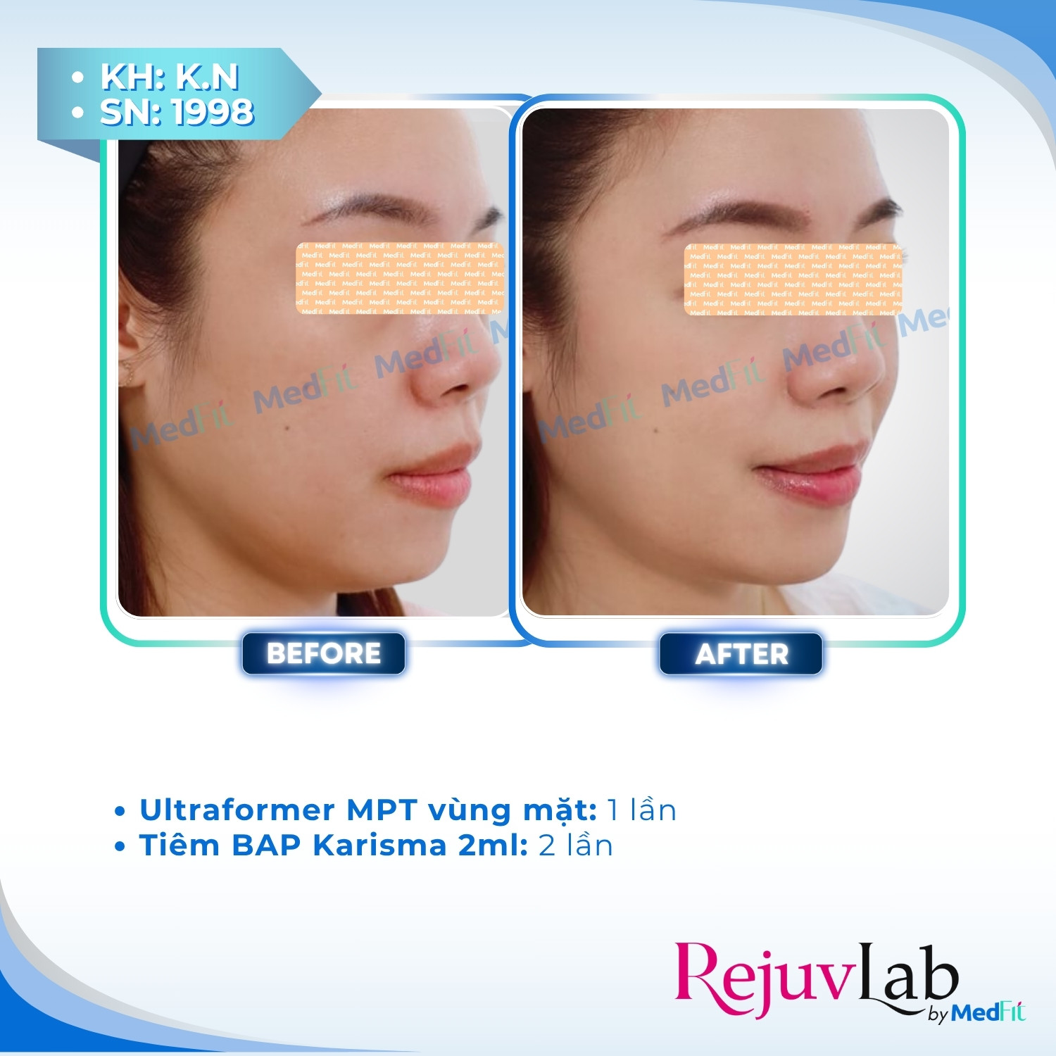 Giảm mỡ vùng mặt - trị nọng cằm 5