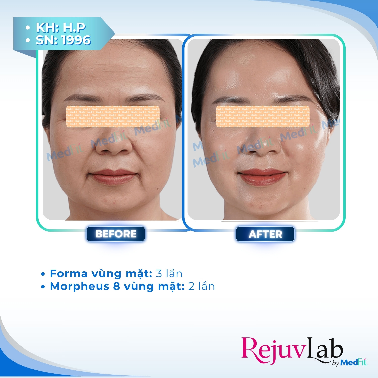 Nâng cơ và trẻ hóa da - căn chỉnh khuôn mặt 68