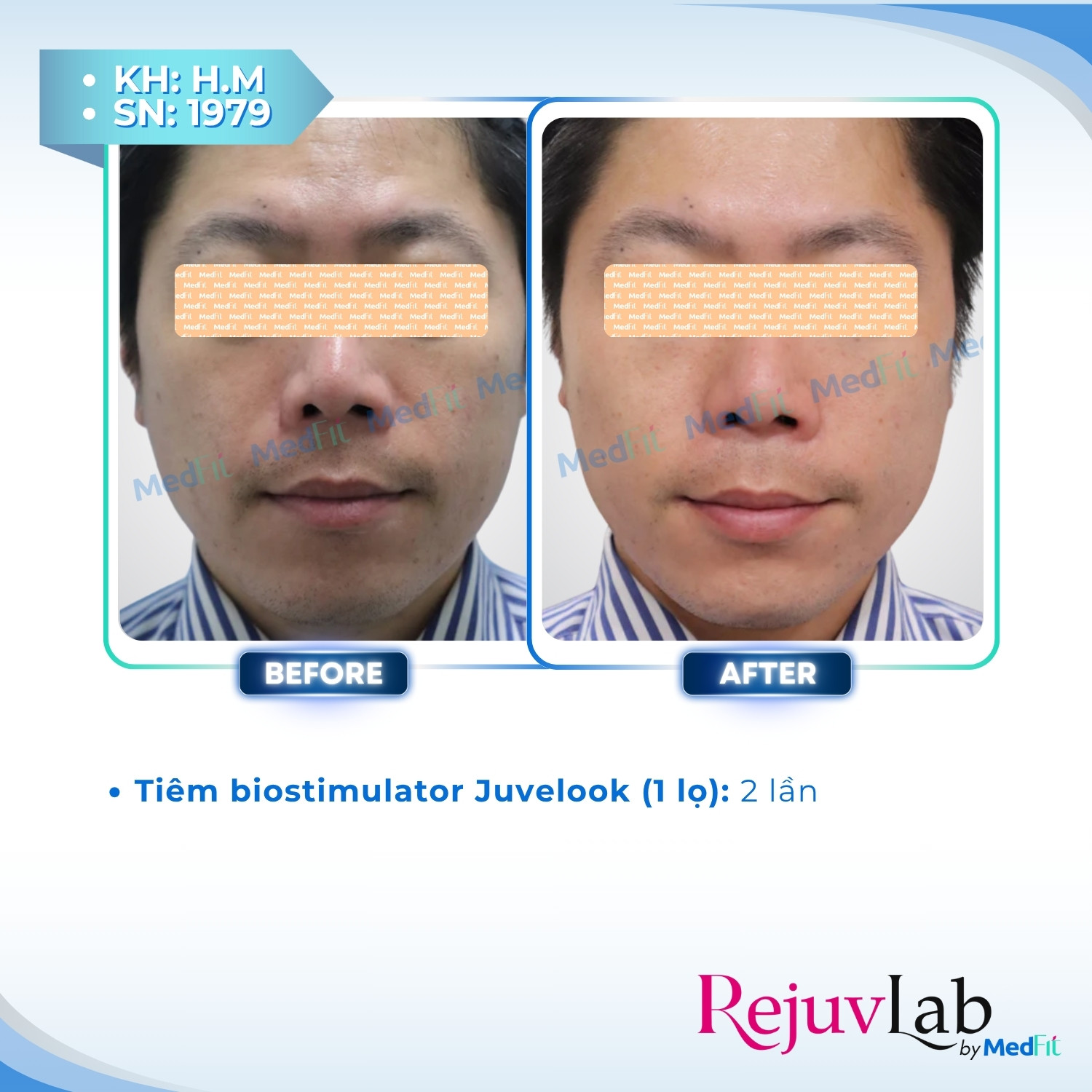 Nâng cơ và trẻ hóa da - căn chỉnh khuôn mặt 69