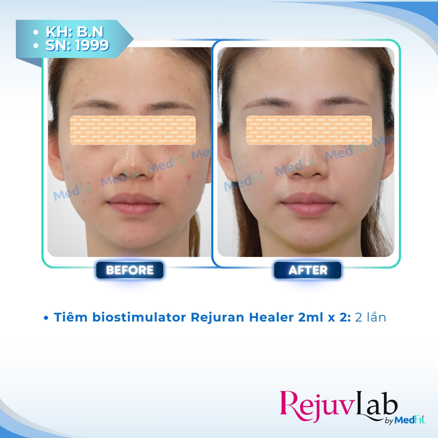 Nâng cơ và trẻ hóa da - căn chỉnh khuôn mặt 70