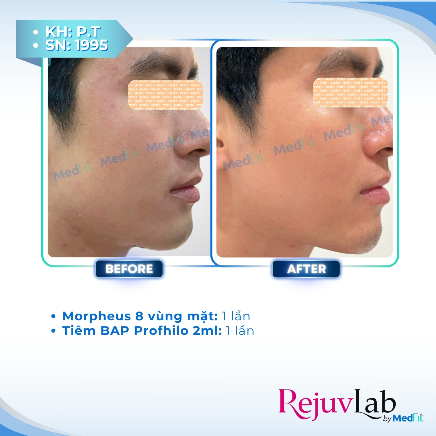 Giảm mỡ vùng mặt - trị nọng cằm 9