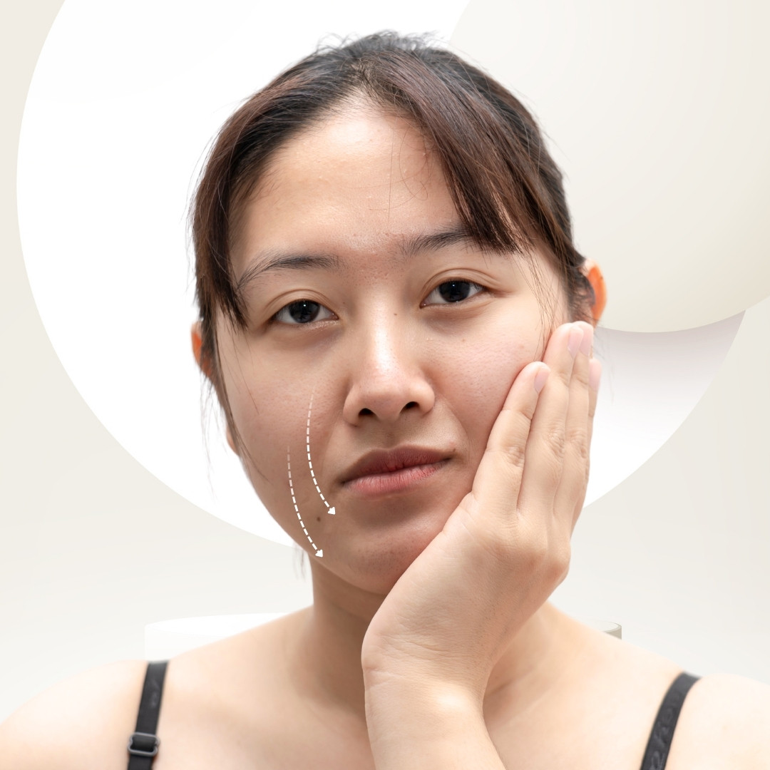 Profhilo Structura – Phương pháp cấp ẩm và trẻ hóa mô mỡ với hyaluronic acid 7