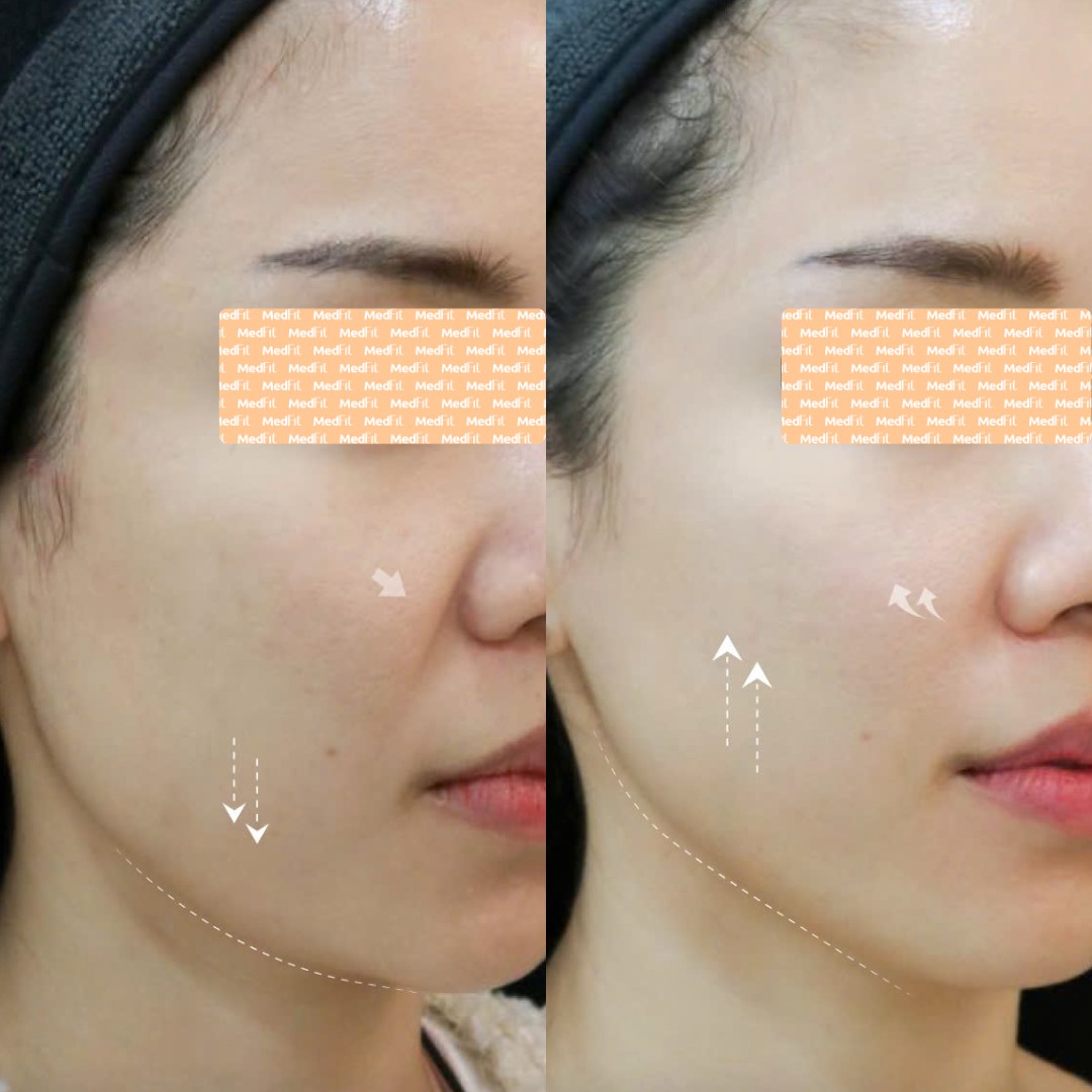 Da săn chắc - hiệu ứng nâng cơ mặt
