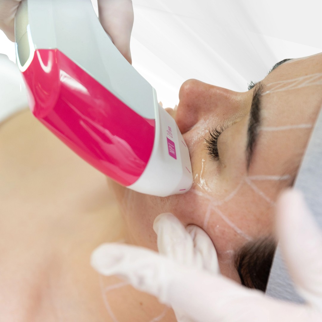 Ultraformer có mặt tại RejuvLab