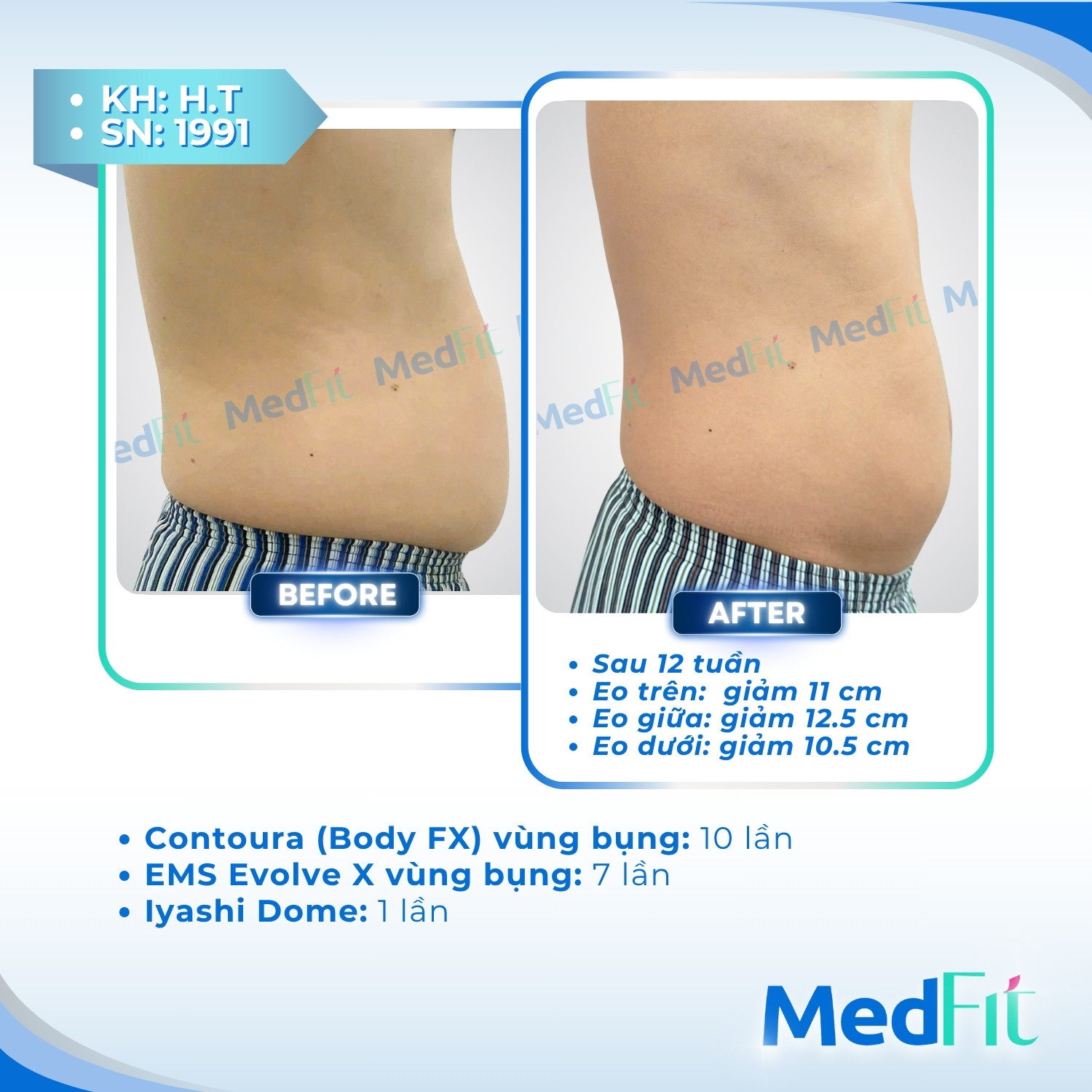 Body FX – Giải pháp giảm mỡ cơ thể vĩnh viễn, lấy lại làn da săn chắc và đàn hồi 2