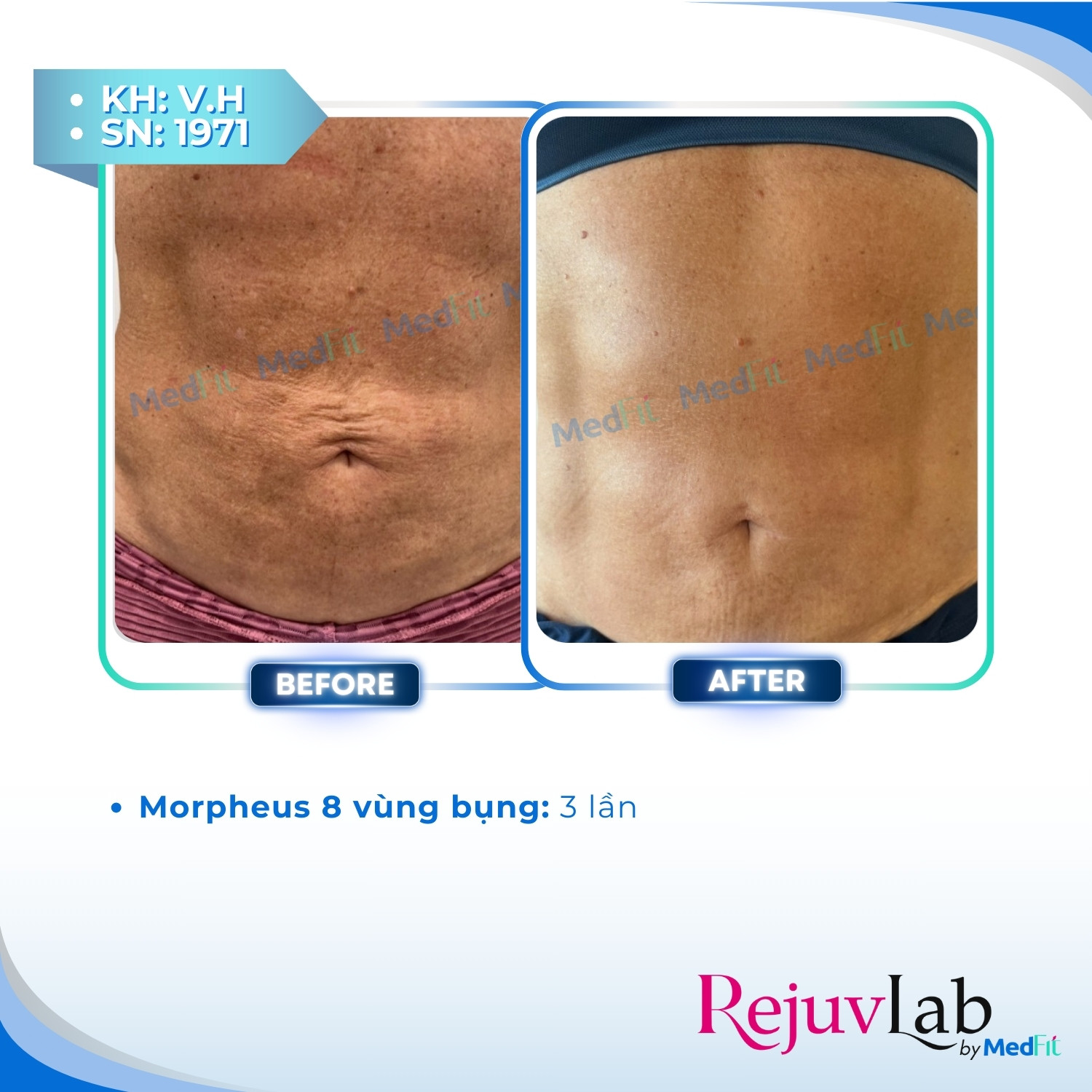 Morpheus8 Body - Công nghệ kiến tạo đường nét cơ thể và tái tạo làn da 4