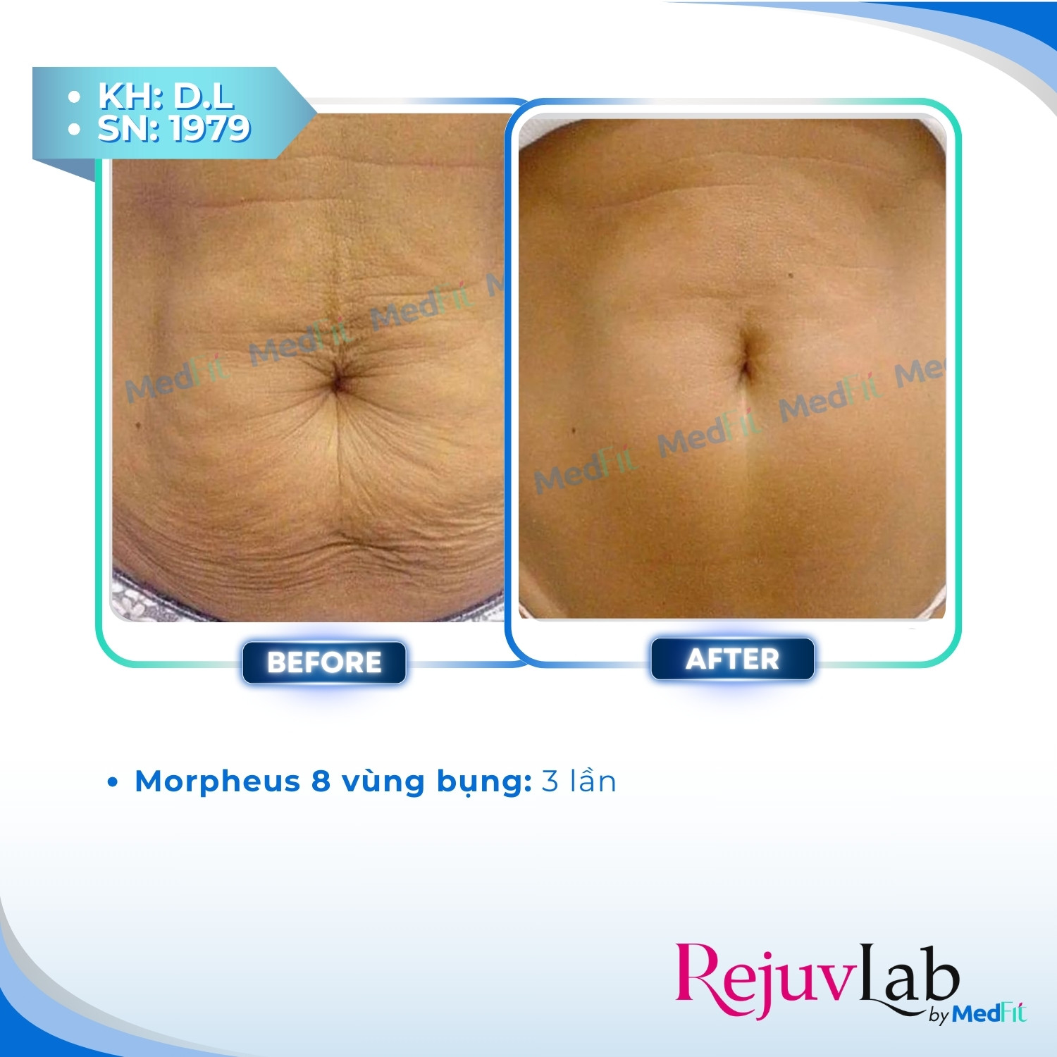Morpheus8 Body - Công nghệ kiến tạo đường nét cơ thể và tái tạo làn da 5