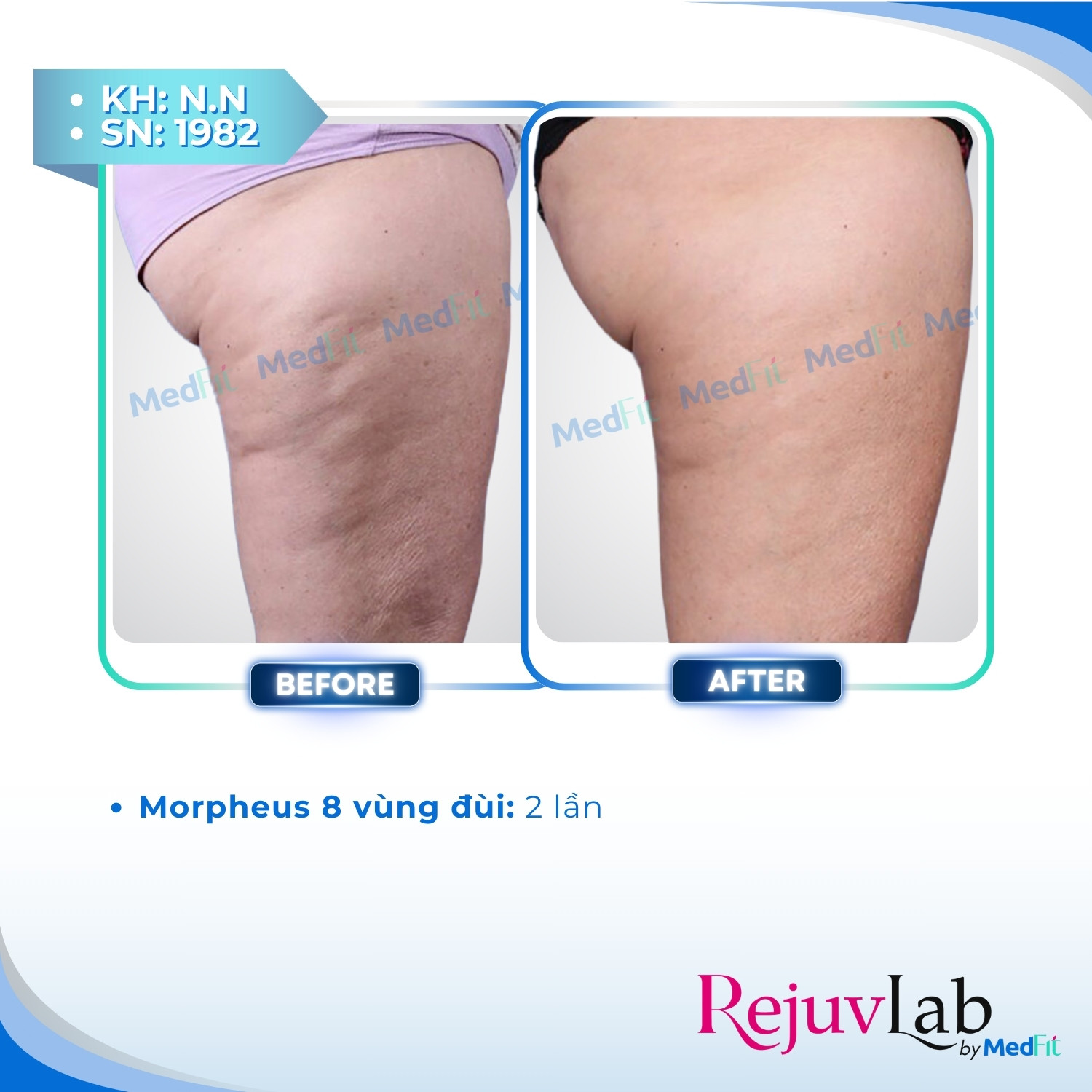 Morpheus8 Body - Công nghệ kiến tạo đường nét cơ thể và tái tạo làn da 6