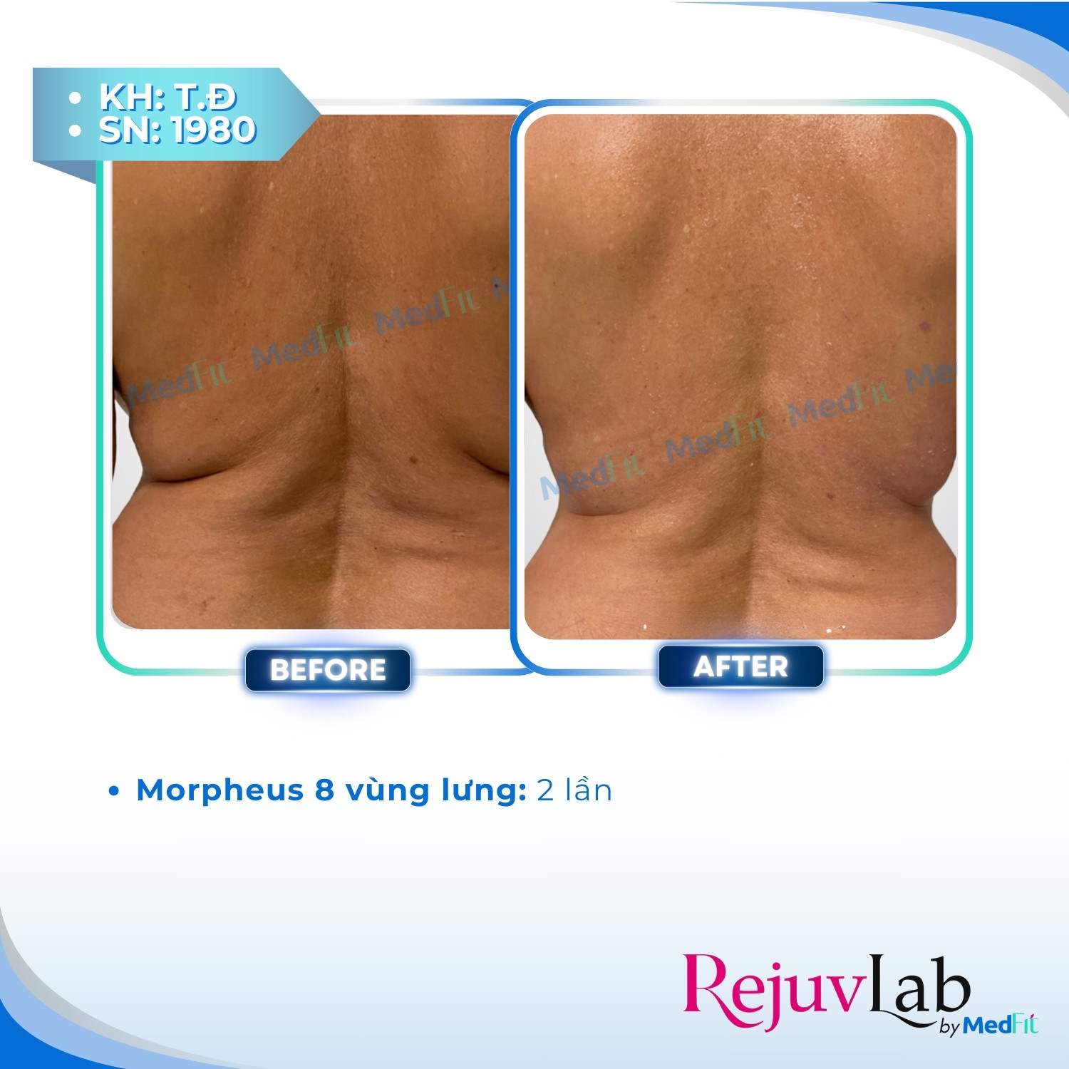 Morpheus8 Body - Công nghệ kiến tạo đường nét cơ thể và tái tạo làn da 7