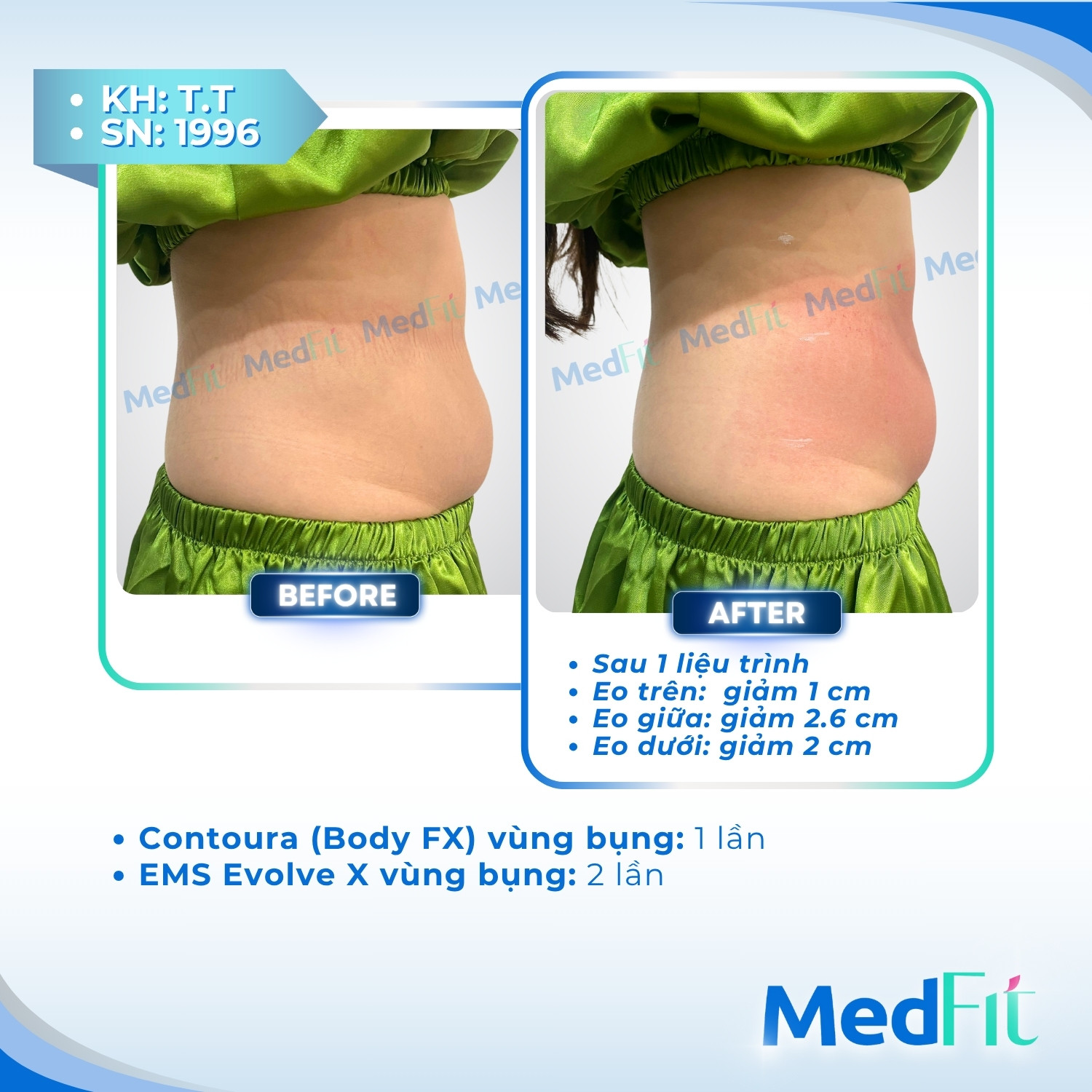 Body FX – Giải pháp giảm mỡ cơ thể vĩnh viễn, lấy lại làn da săn chắc và đàn hồi 4