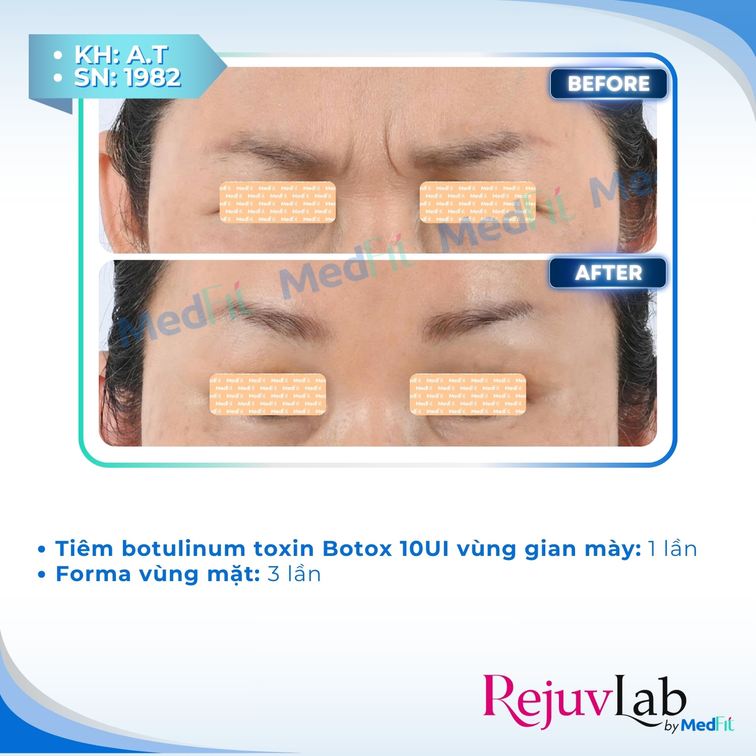 Xóa nếp nhăn lấy lại sự trẻ trung trên gương mặt 15