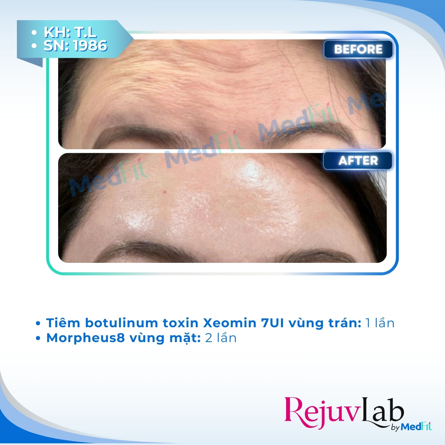 Xóa nếp nhăn lấy lại sự trẻ trung trên gương mặt 16
