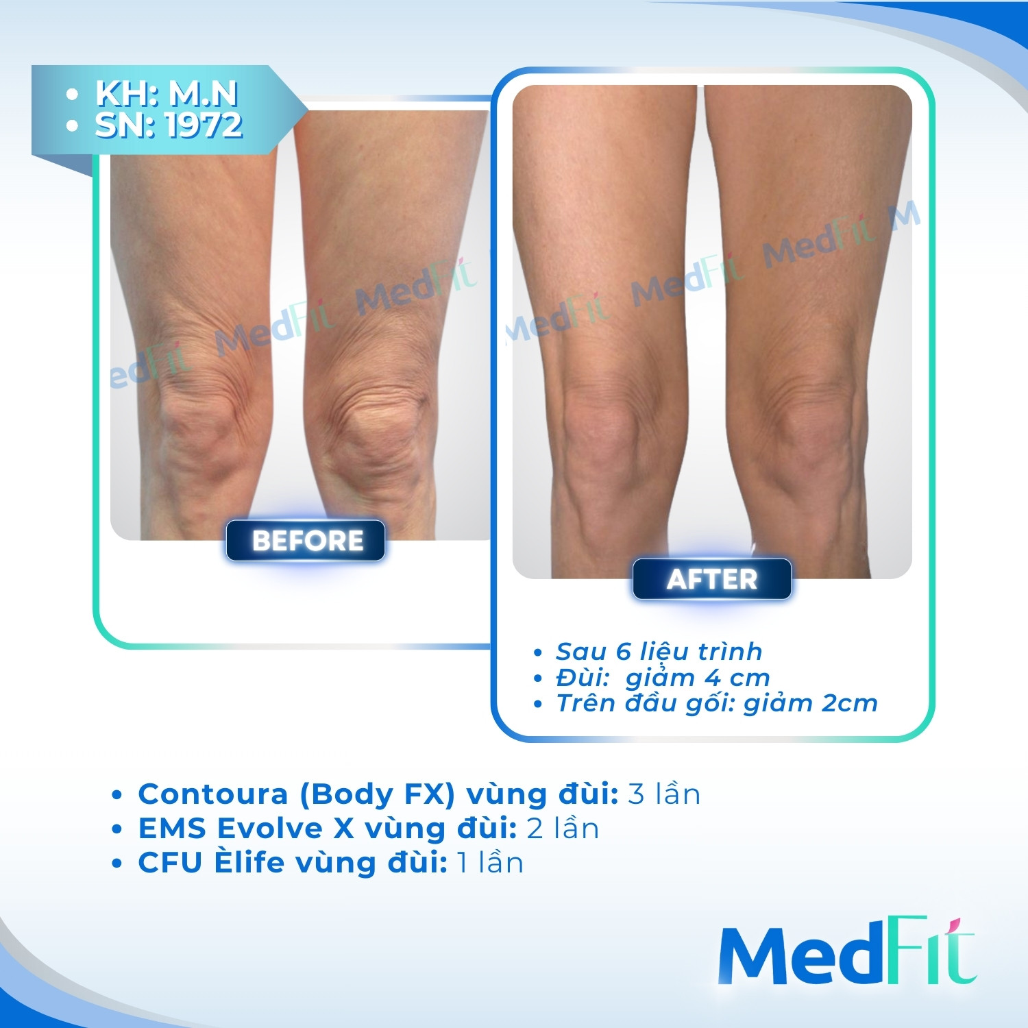 Body FX – Giải pháp giảm mỡ cơ thể vĩnh viễn, lấy lại làn da săn chắc và đàn hồi 7