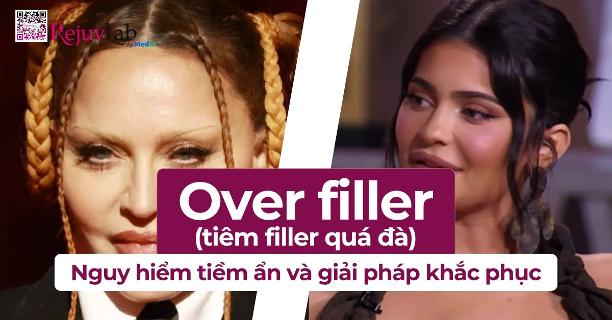 over filler nguy hiểm tiềm ẩn và giải pháp khắc phục