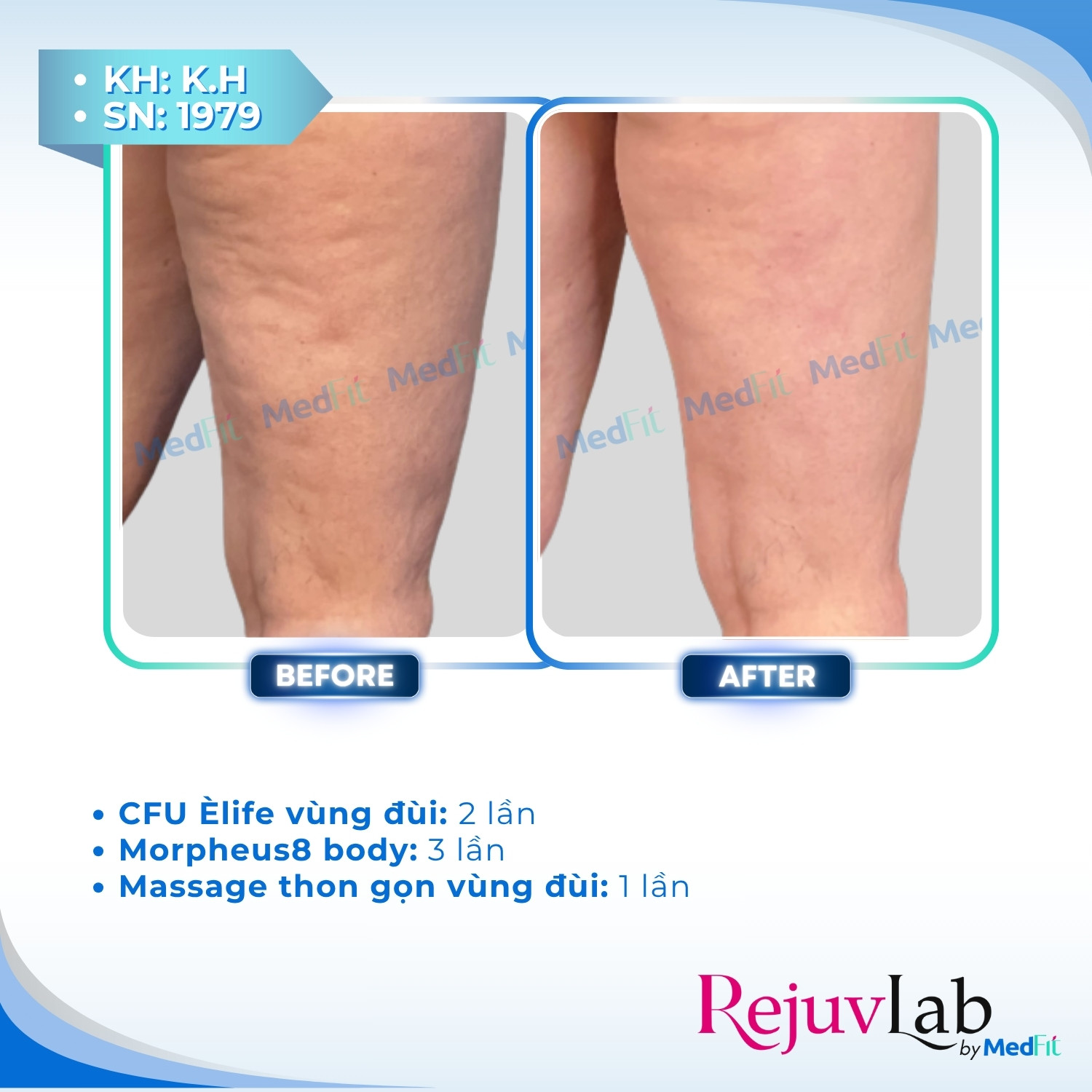 1 Điều trị cellulite 2