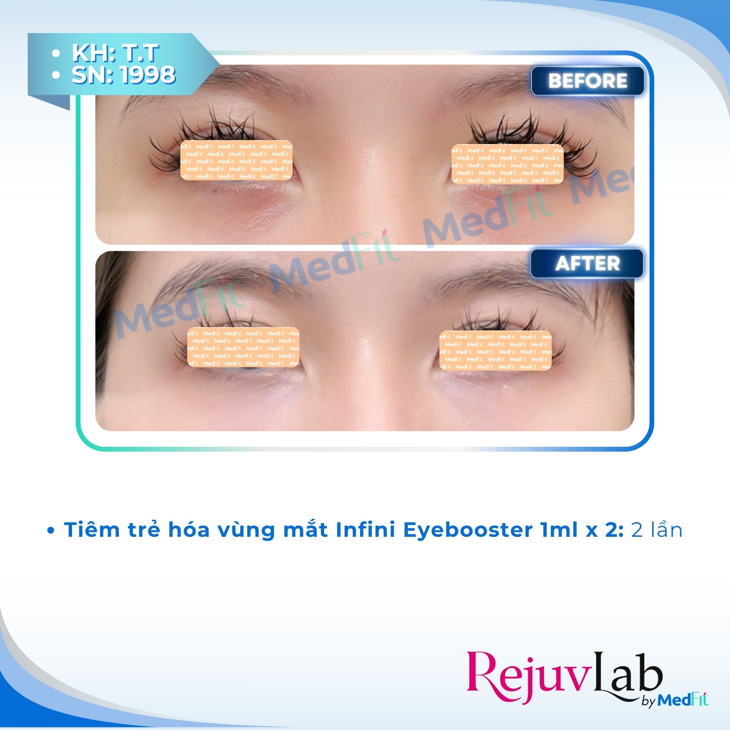 Infini Premium Meso Eyebooster 3