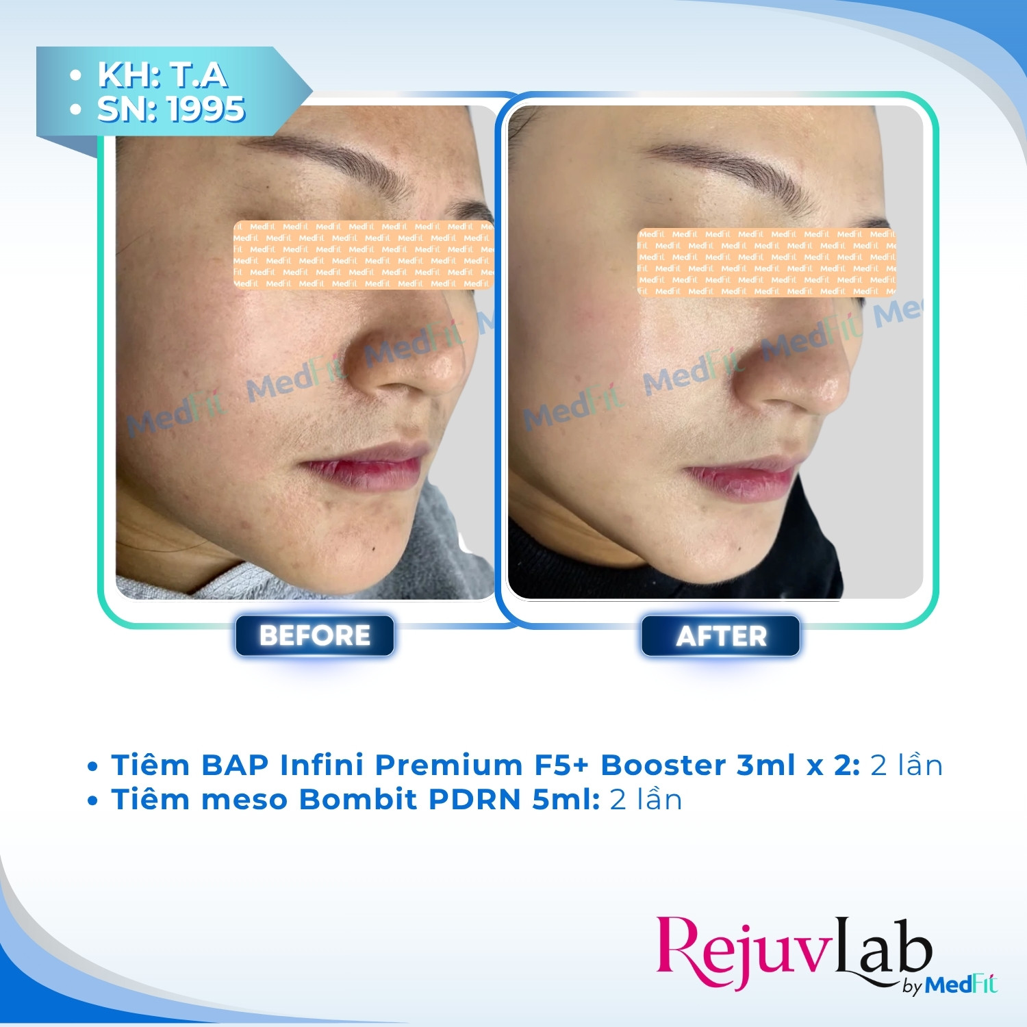 Infini Meso Premium F5+ Booster 4