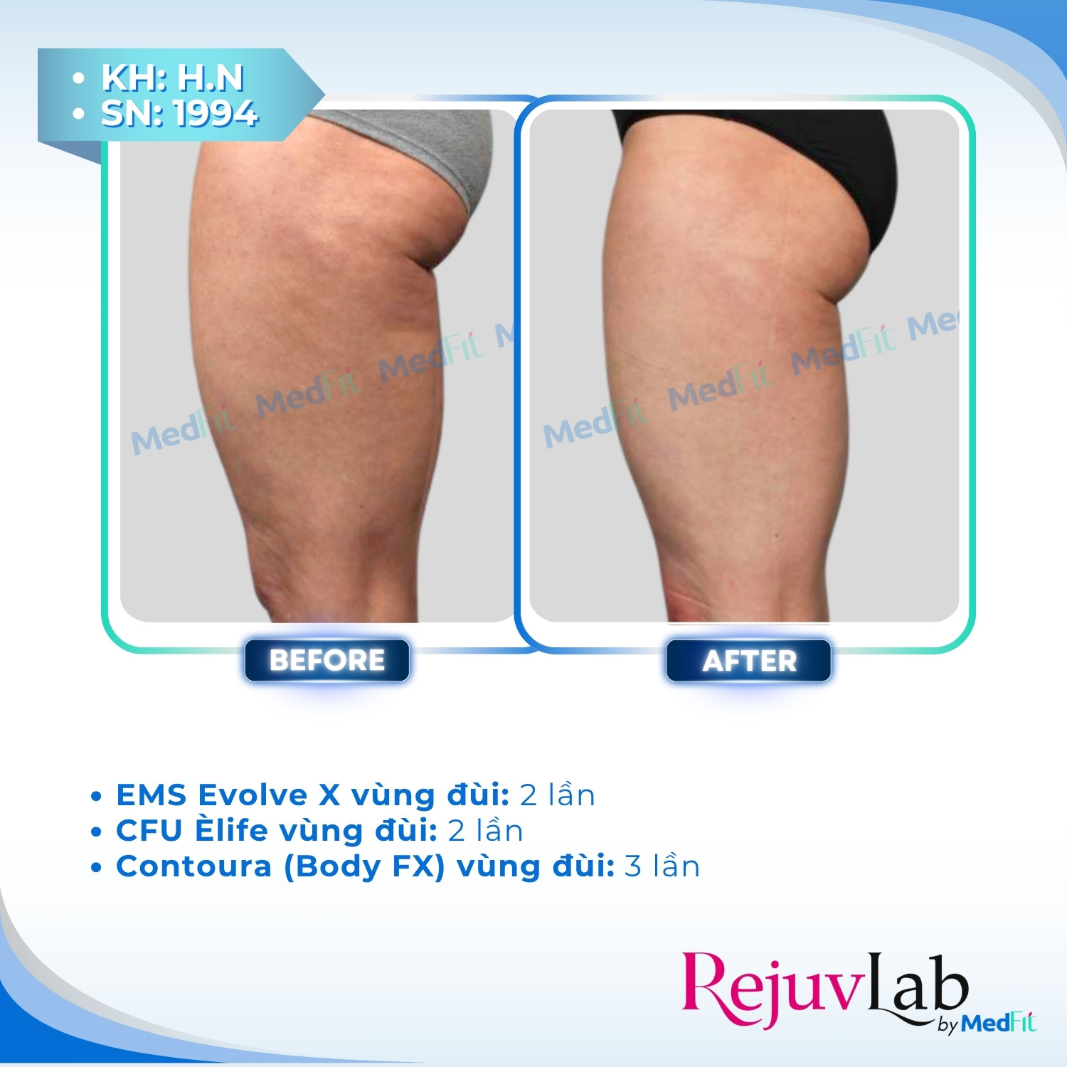 2 Điều trị cellulite 3