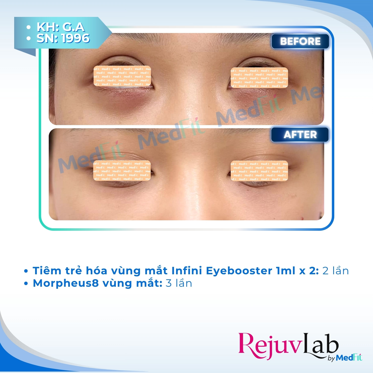 Infini Premium Meso Eyebooster 4