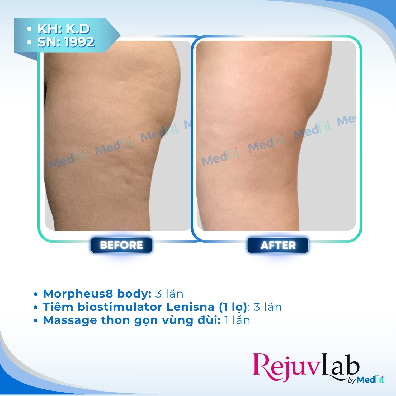 3 Điều trị cellulite 4