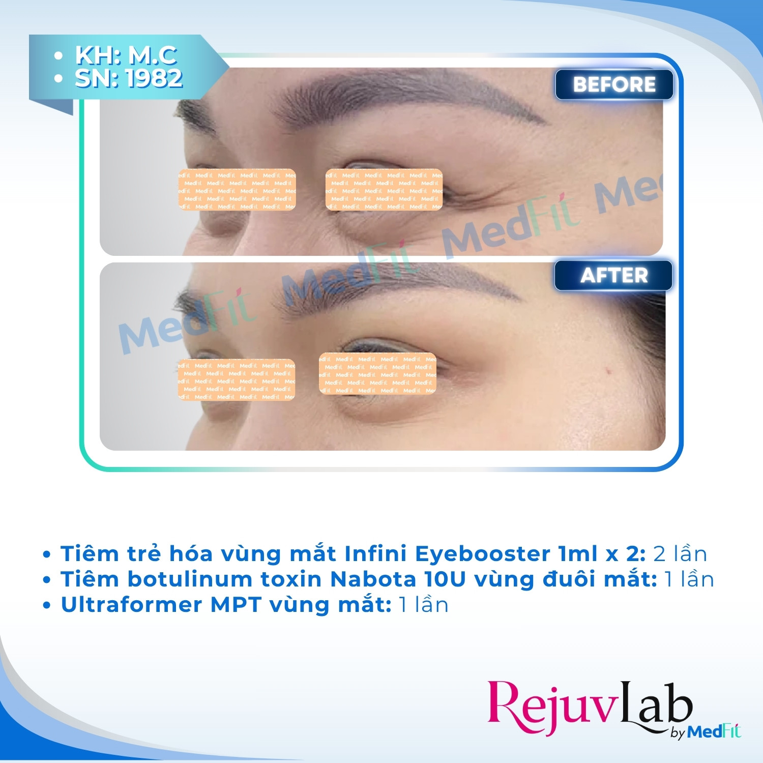 Infini Premium Meso Eyebooster 5