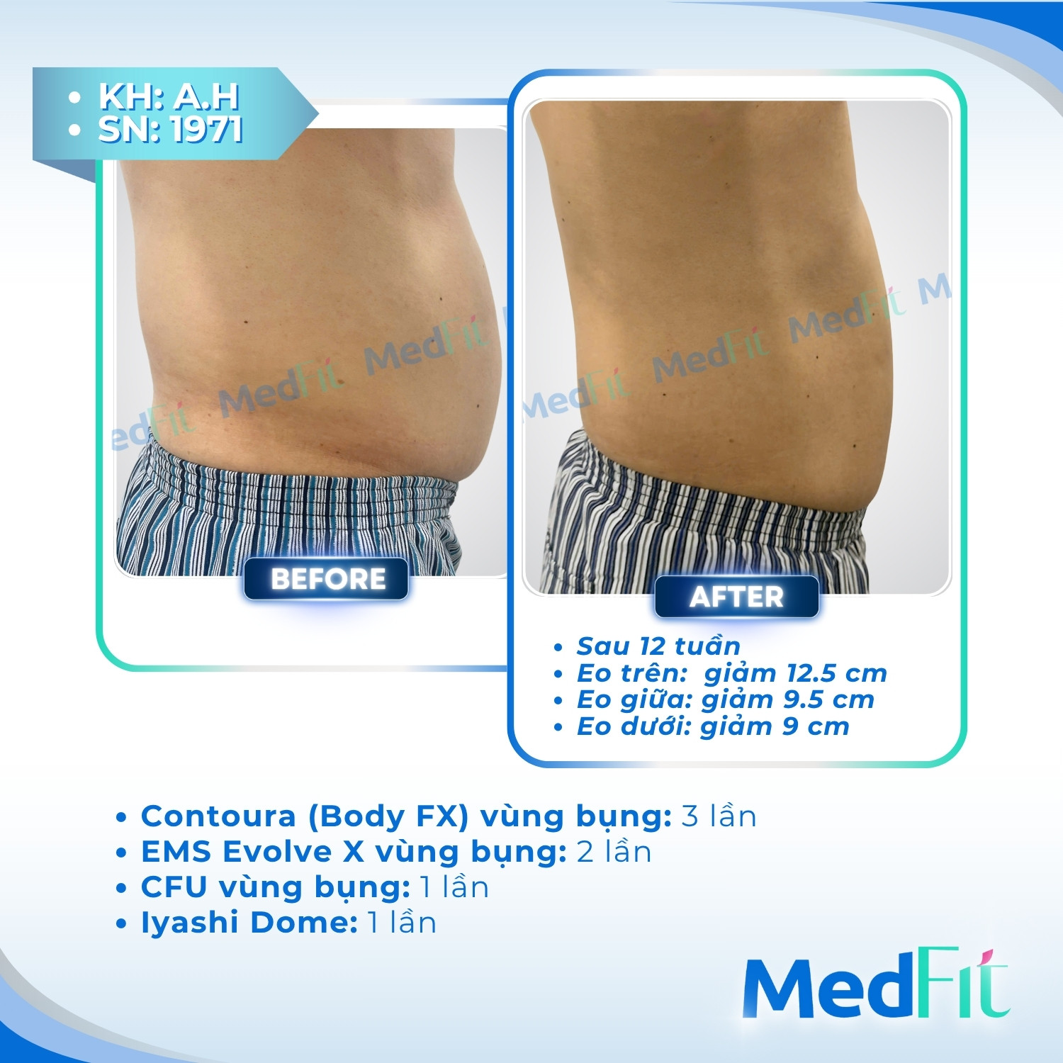 Giảm mỡ 10