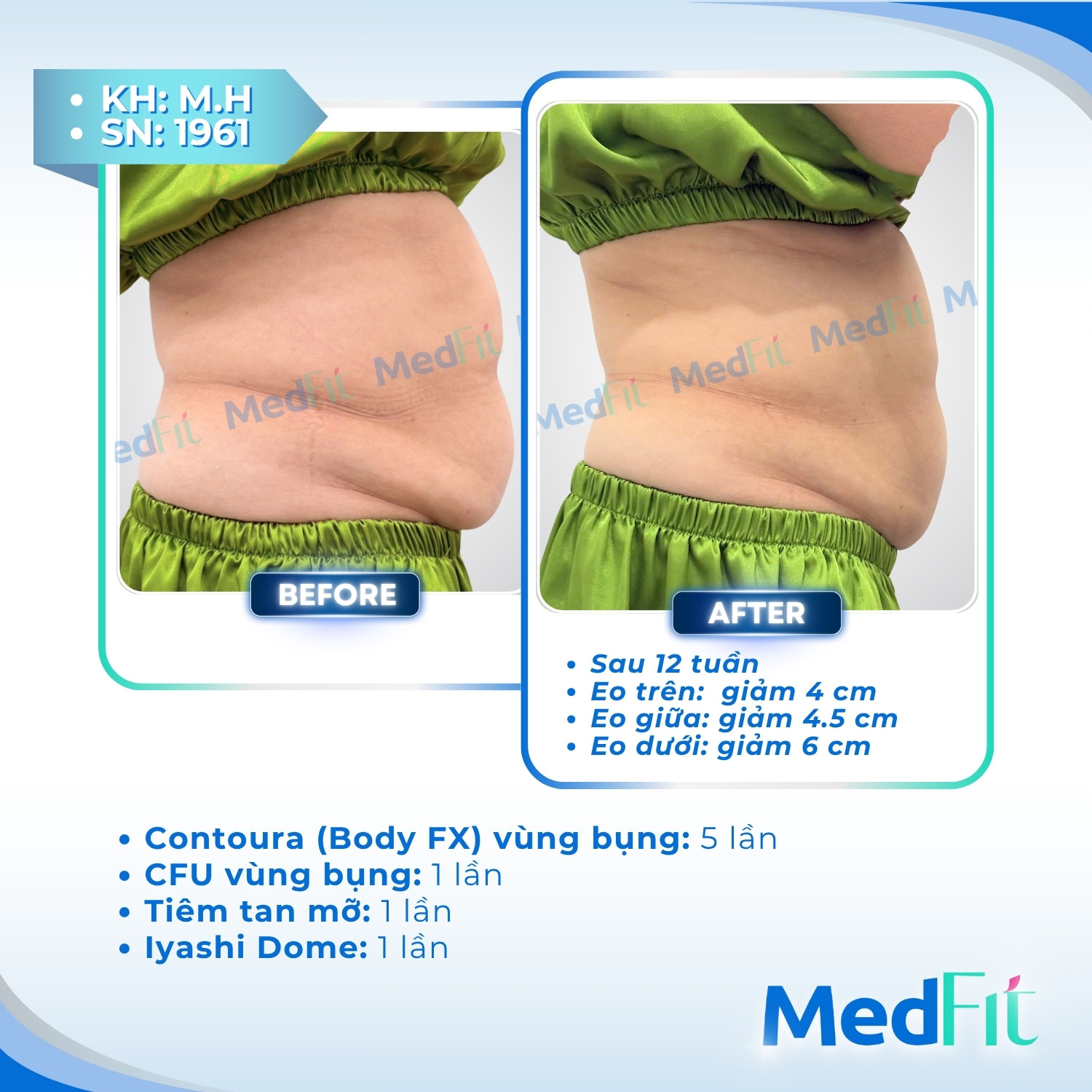Body FX – Giải pháp giảm mỡ cơ thể vĩnh viễn, lấy lại làn da săn chắc và đàn hồi 11