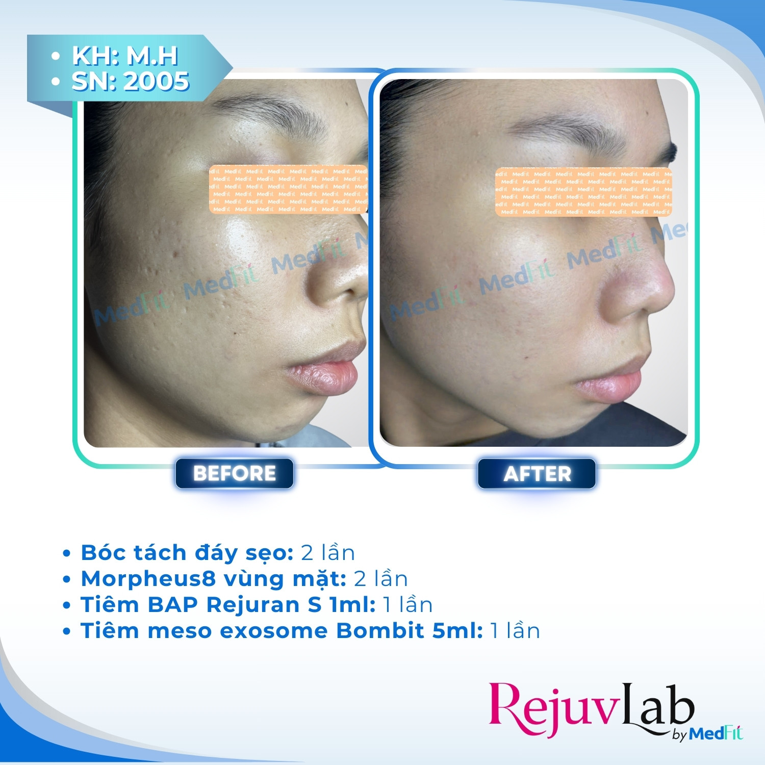 4 Trị sẹo rỗ 2