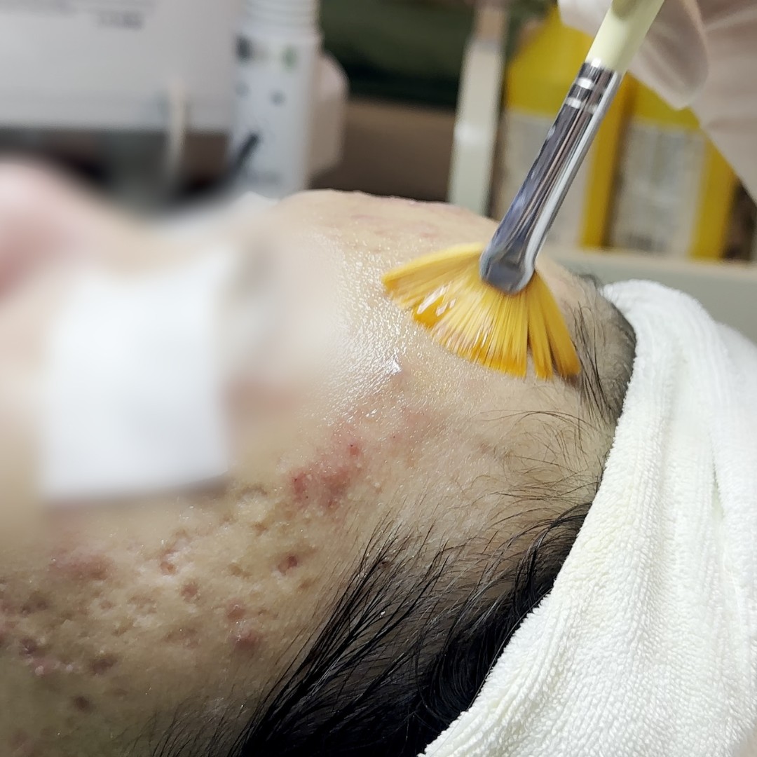 Peel da điều trị sẹo rỗ và sẹo sau mụn Peel da điều trị sẹo rỗ và sẹo sau mụn