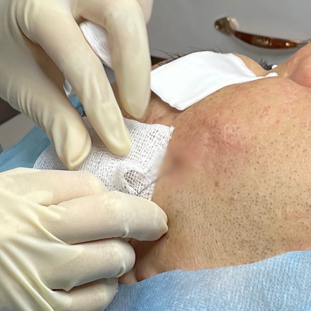 Tách đáy sẹo Tách đáy sẹo