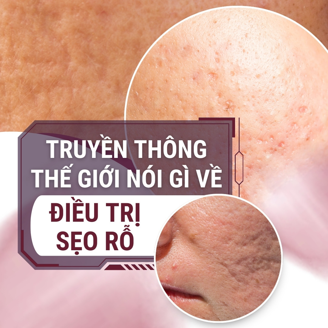 Truyền thông nói gì về Điều trị sẹo rỗ Truyền thông nói gì về Điều trị sẹo rỗ