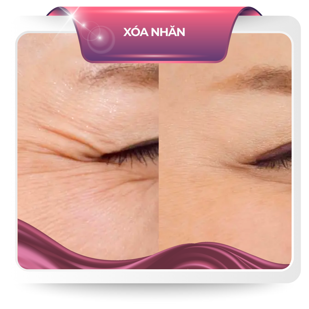 Xóa nhăn