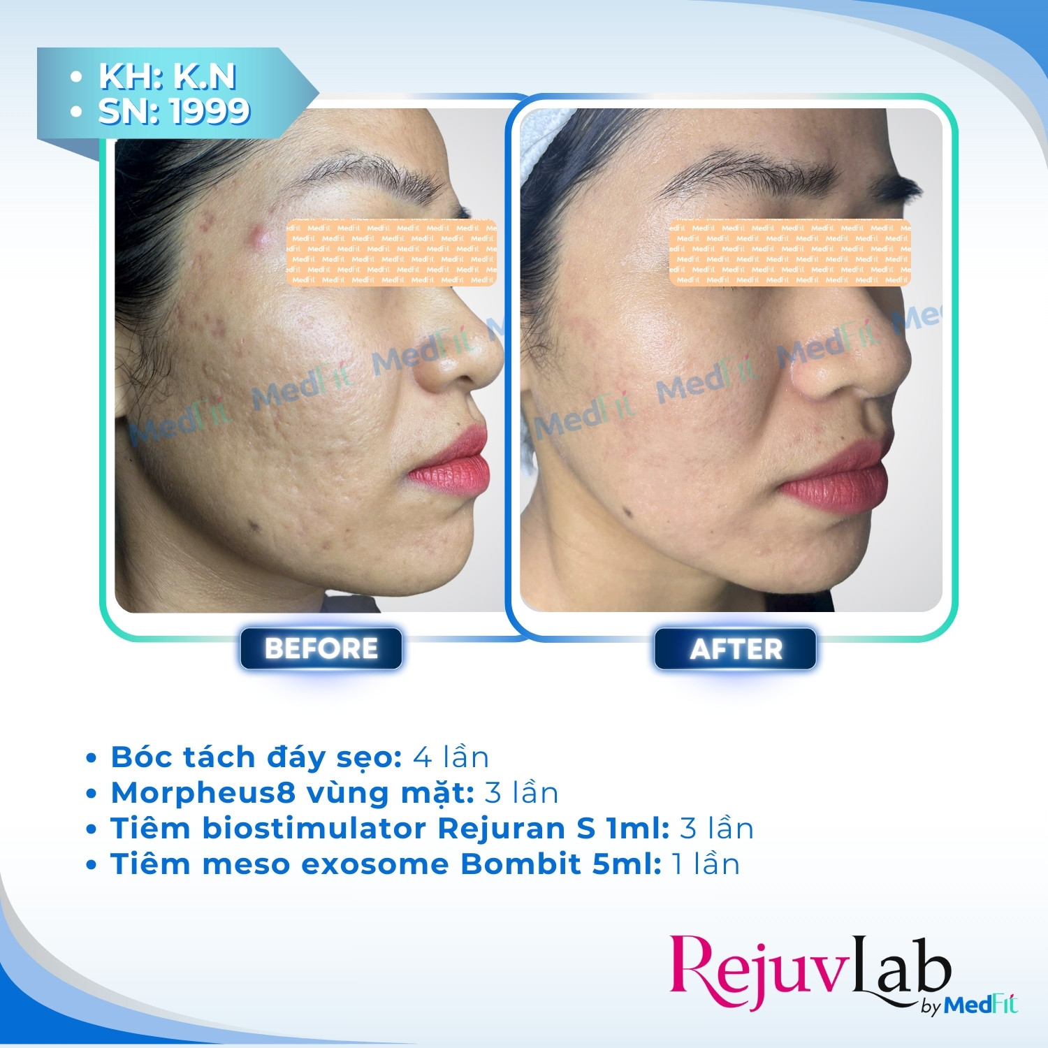 3 Trị sẹo rỗ 1
