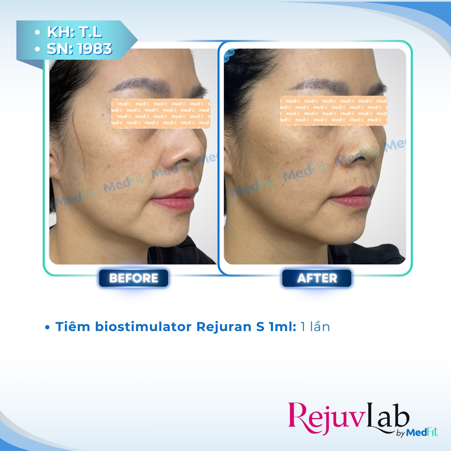 Morpheus8 - Công nghệ đỉnh cao giúp giảm mỡ mặt và trẻ hóa làn da 9