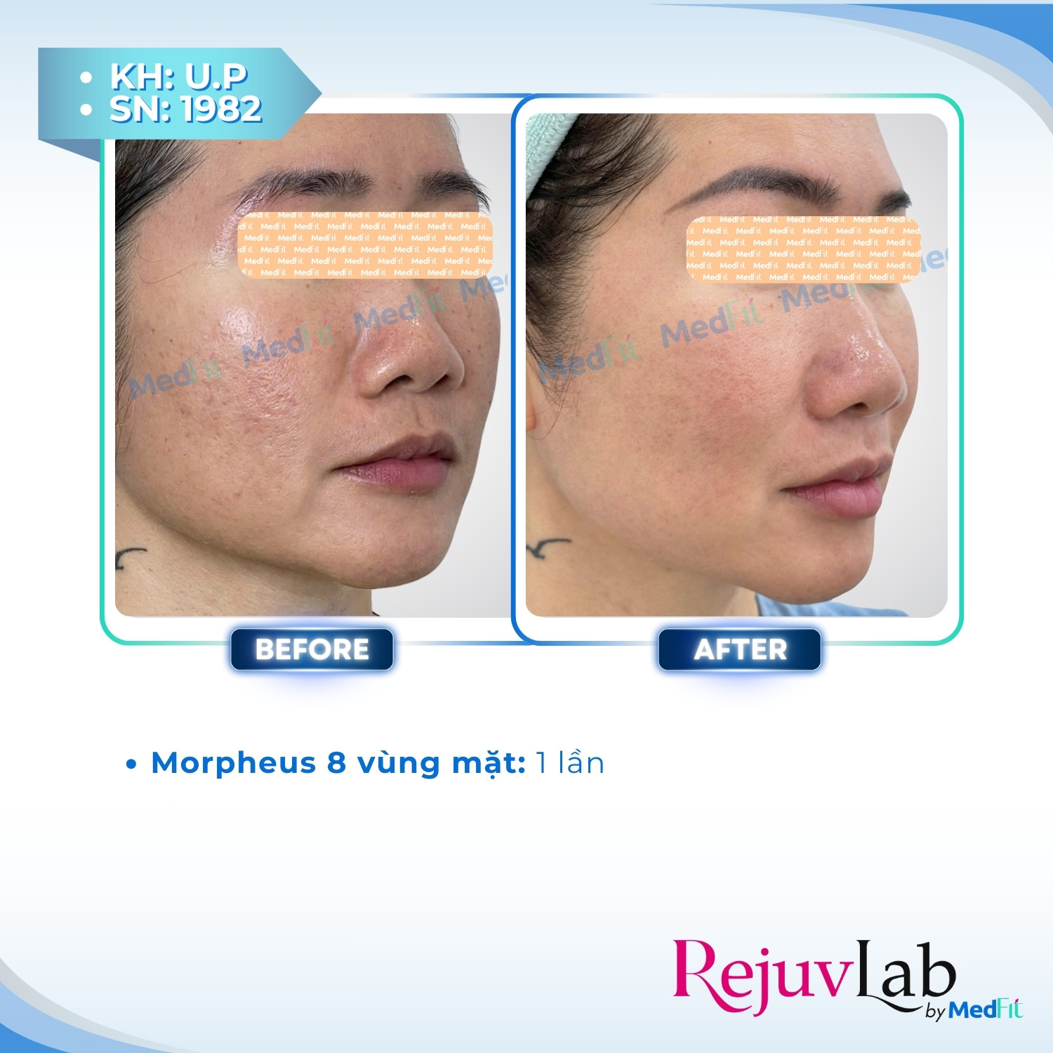 CLS - UP - Morpheus8 sẹo rỗ Trị sẹo rỗ 4