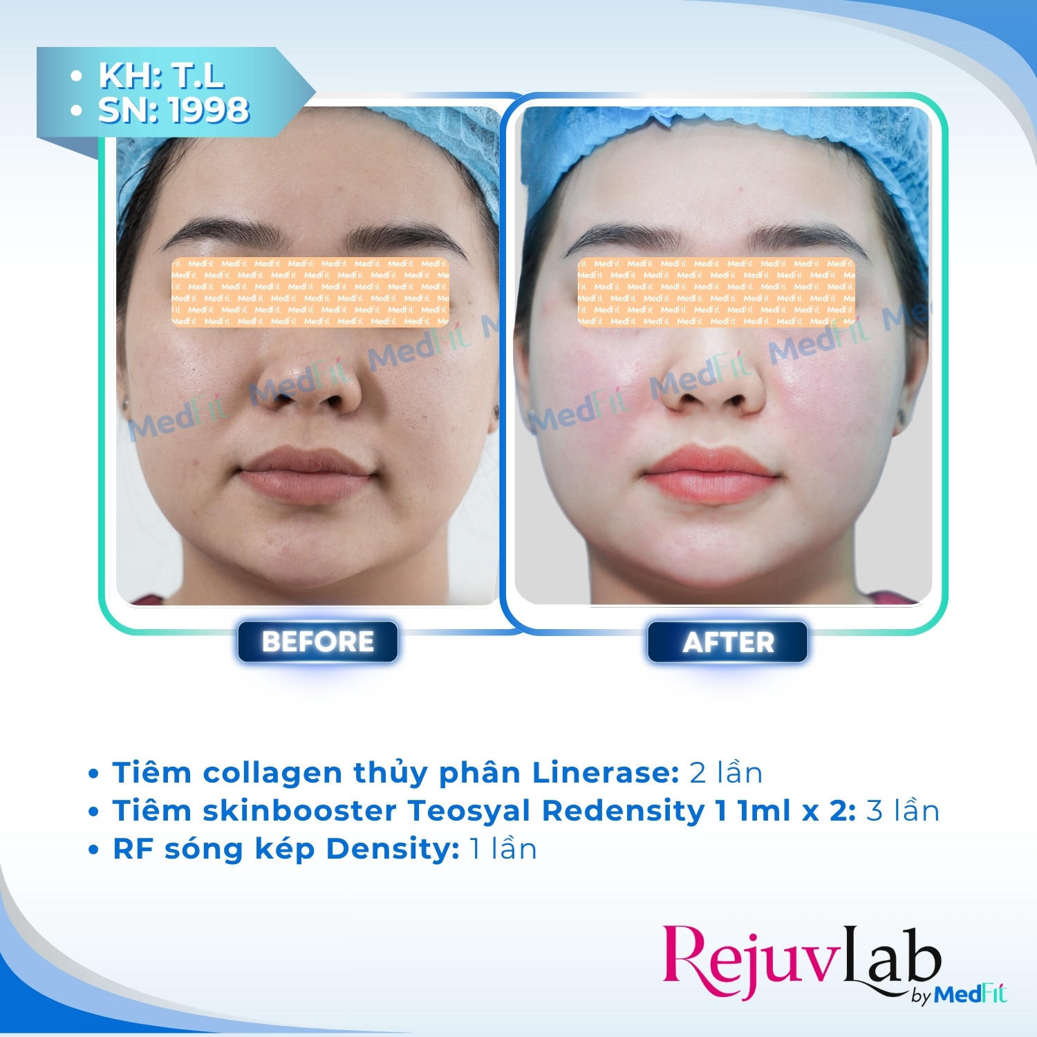 Linerase - Sản phẩm tiêm tăng sinh collagen và tái tạo mô liên kết 1