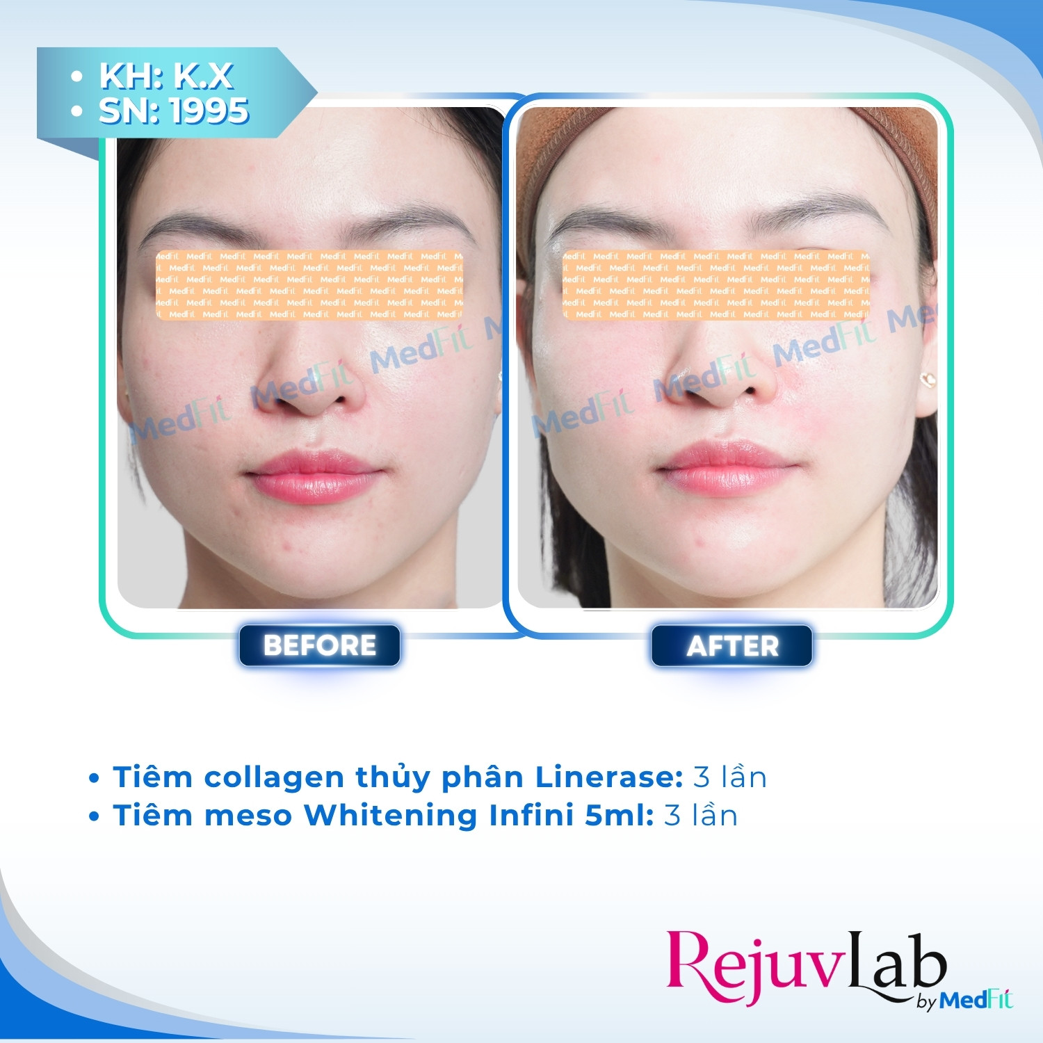 Linerase - Sản phẩm tiêm tăng sinh collagen và tái tạo mô liên kết 2