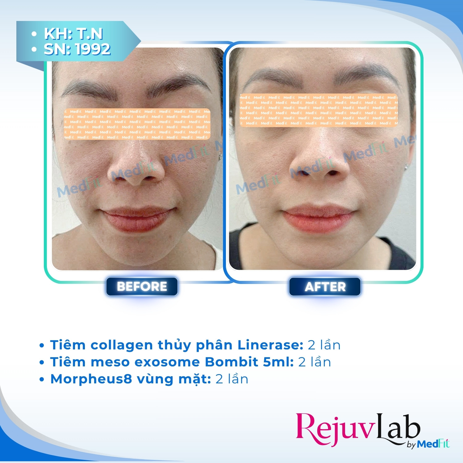 Linerase - Sản phẩm tiêm tăng sinh collagen và tái tạo mô liên kết 3