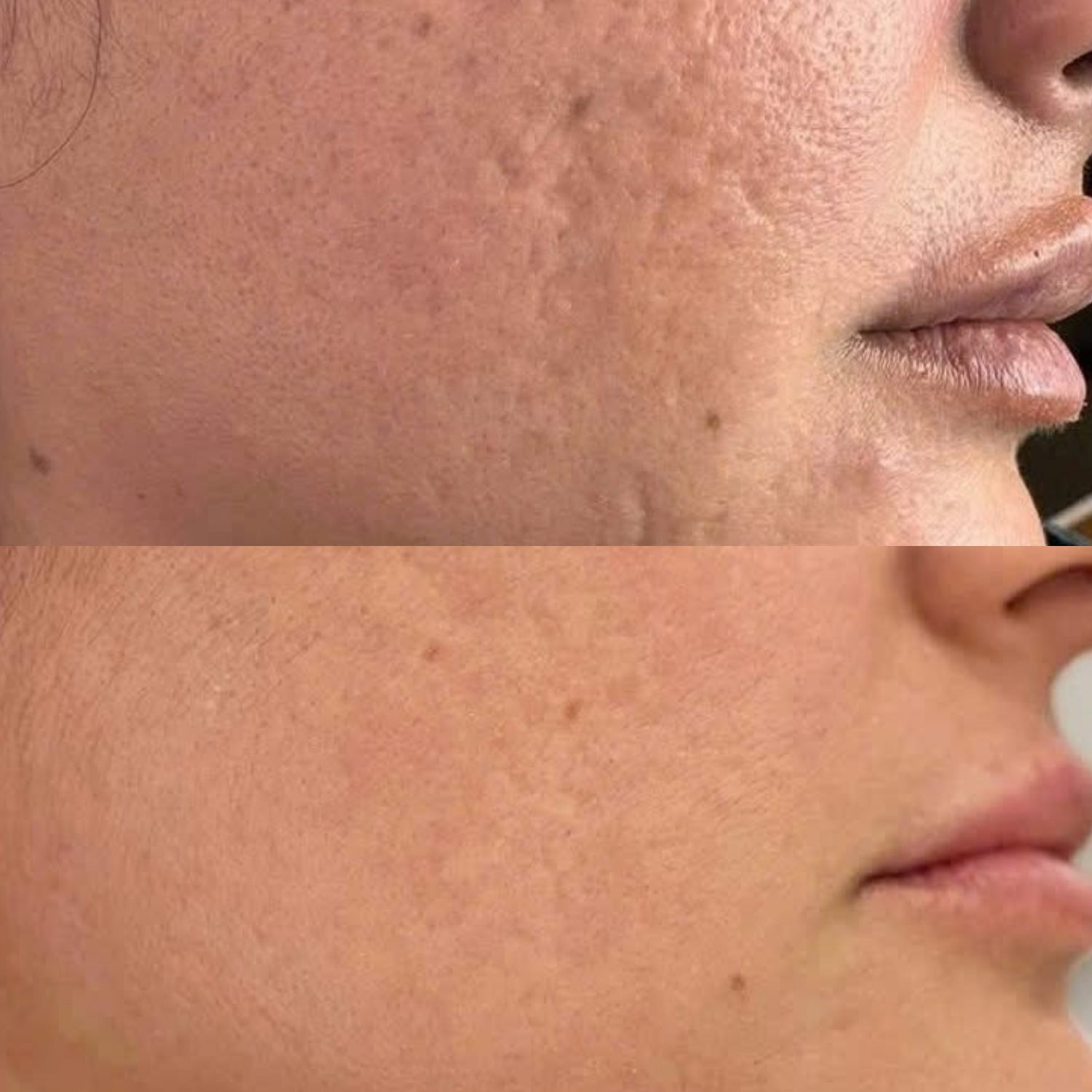 Cải thiện sẹo rỗ