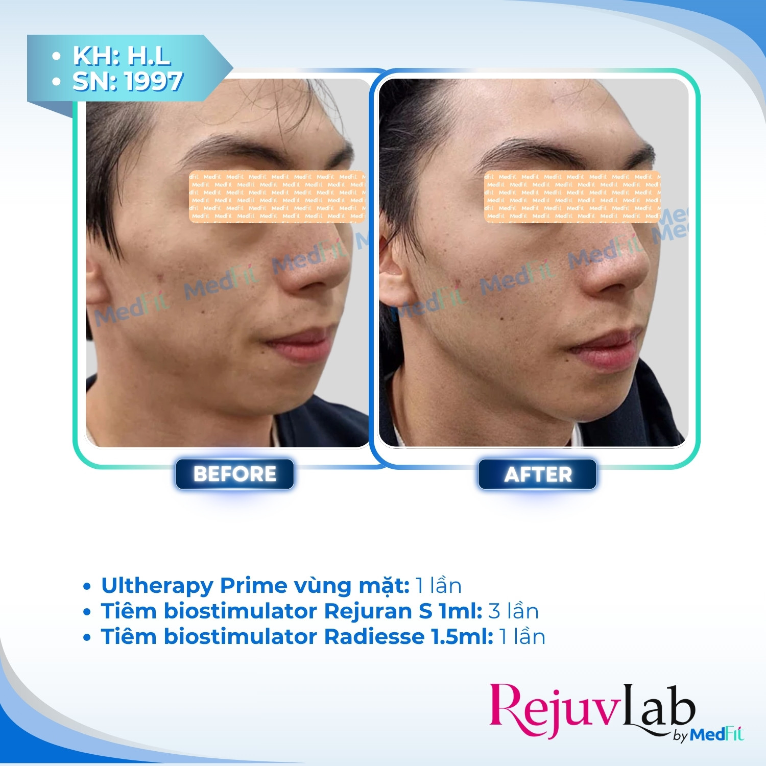 Ultherapy Prime - Tiêu chuẩn vàng của HIFU trong nâng cơ - trẻ hoá da 3