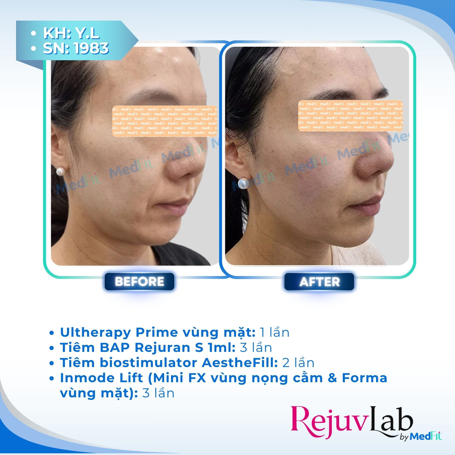 Ultherapy Prime - Tiêu chuẩn vàng của HIFU trong nâng cơ - trẻ hoá da 4