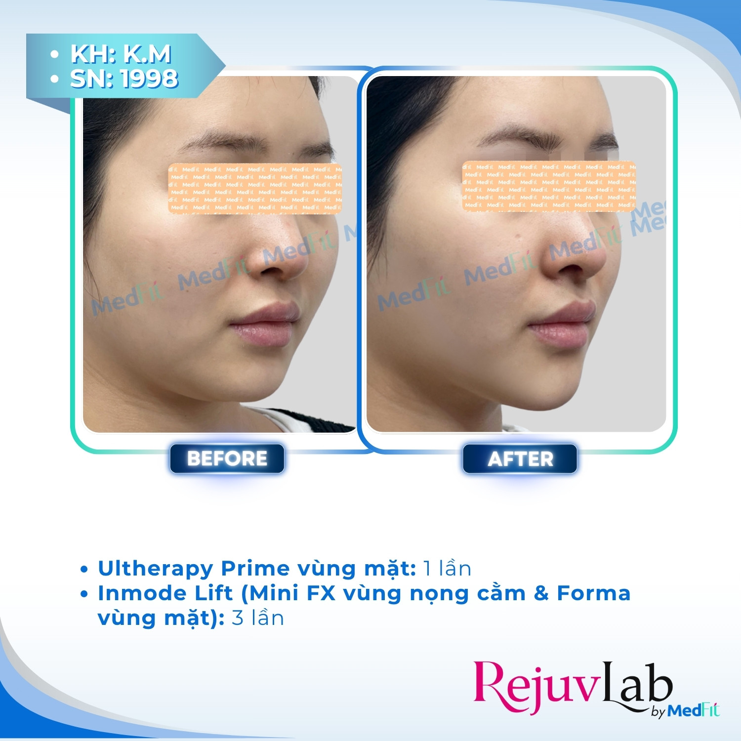 Ultherapy Prime - Tiêu chuẩn vàng của HIFU trong nâng cơ - trẻ hoá da 5
