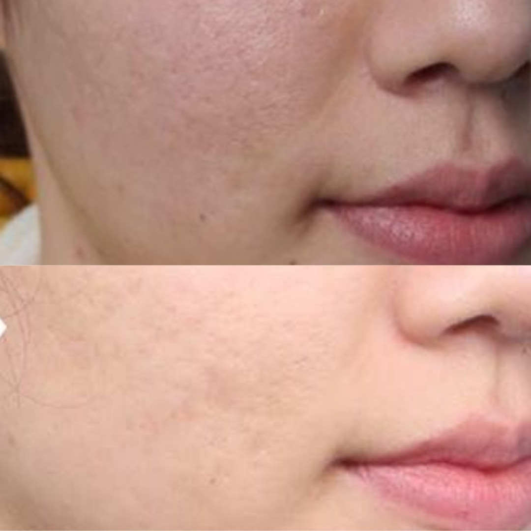 Hiệu ứng trẻ hóa tự nhiên, không làm thay đổi đường nét