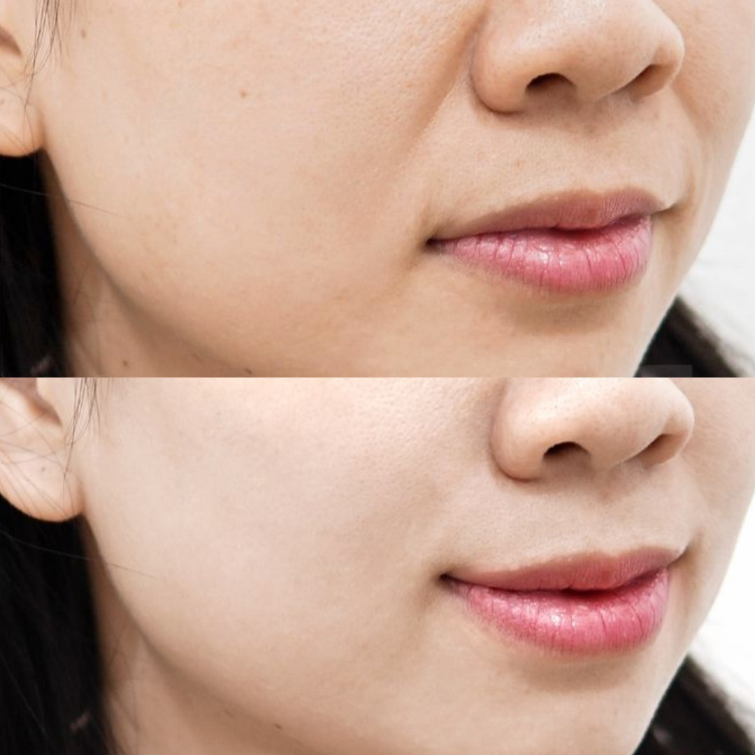 Nếp nhăn được cải thiện rõ rệt